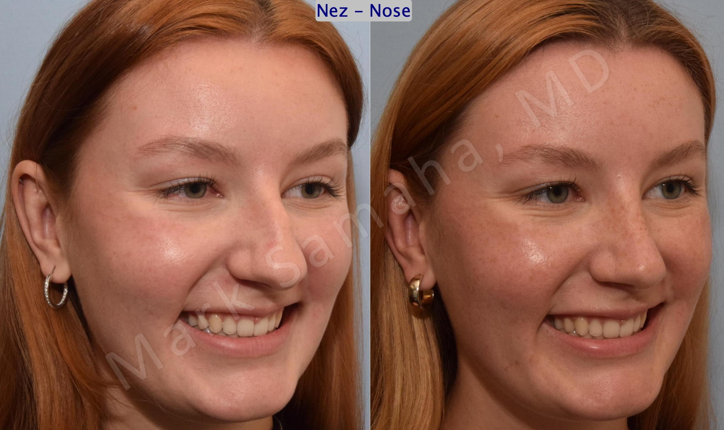 Before & After Rhinoplastie / Rhinoplasty Case 193 Right Oblique Smile View in Mount Royal, QC