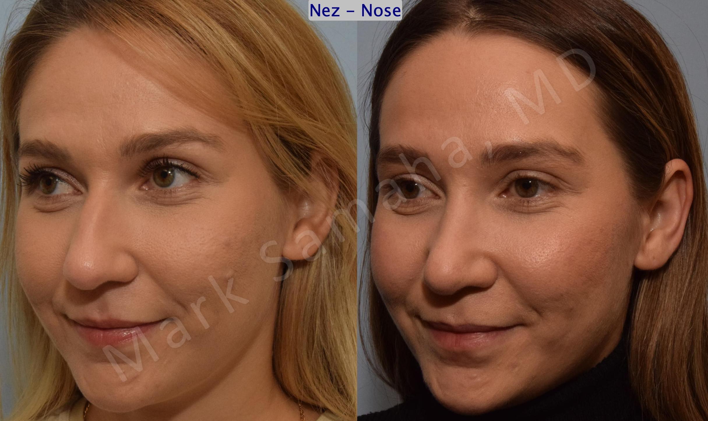 Before & After Rhinoplastie / Rhinoplasty Case 194 Left Oblique Smile View in Mount Royal, QC
