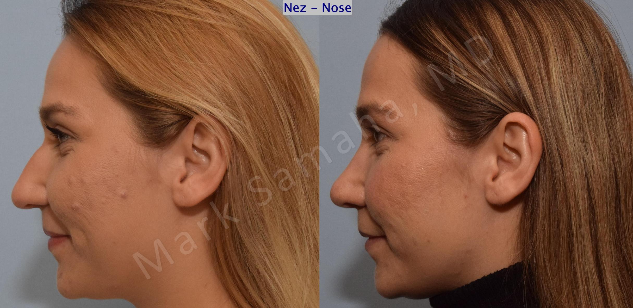 Before & After Rhinoplastie / Rhinoplasty Case 194 Left Side Smile View in Mount Royal, QC