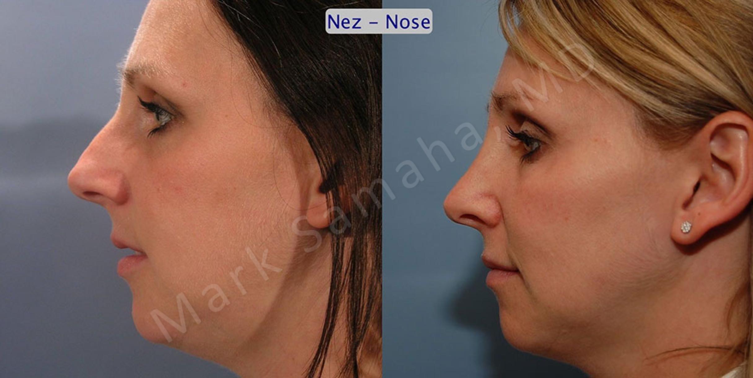 Before & After Rhinoplastie / Rhinoplasty Case 33 View #1 View in Mount Royal, QC