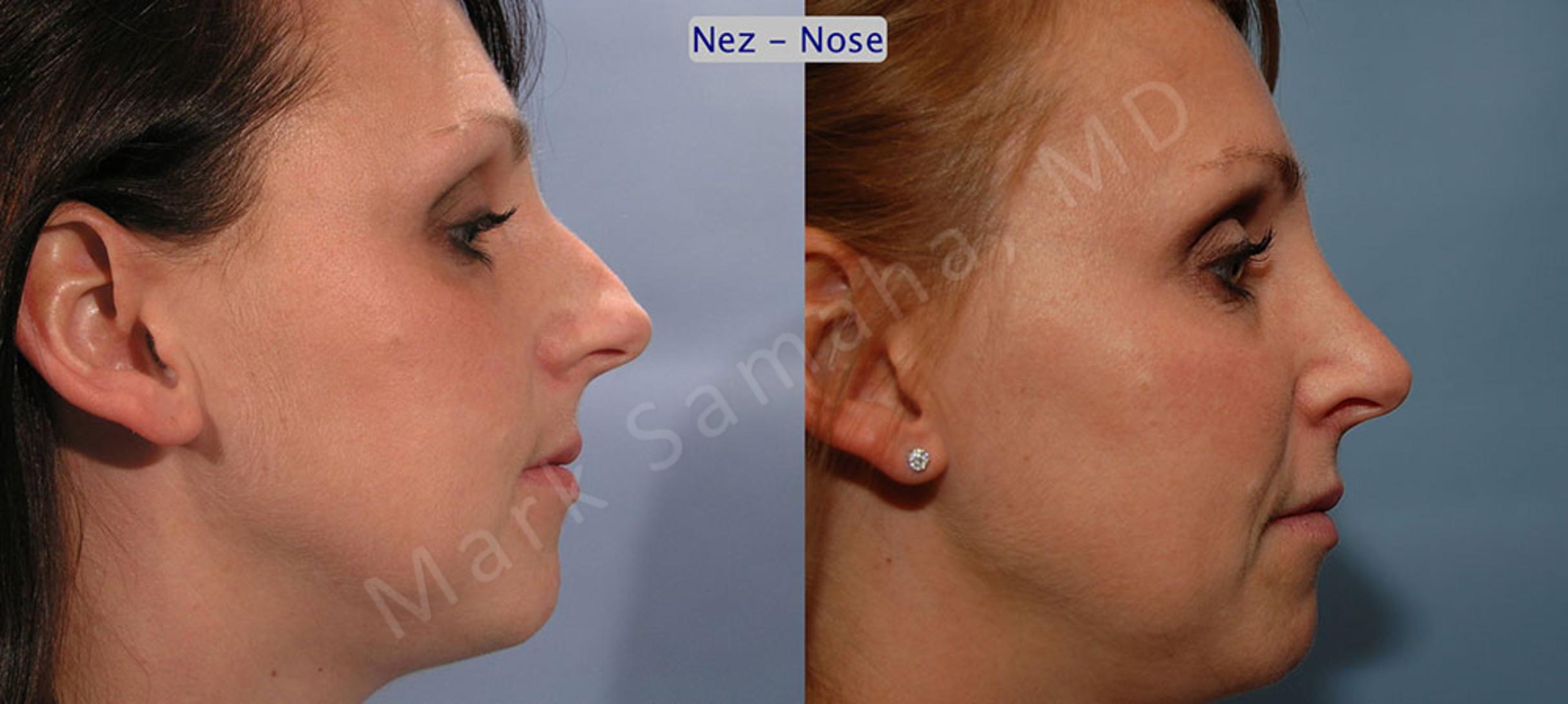 Before & After Rhinoplasty / Rhinoplastie Case 33 View #4 View in Mount Royal, QC