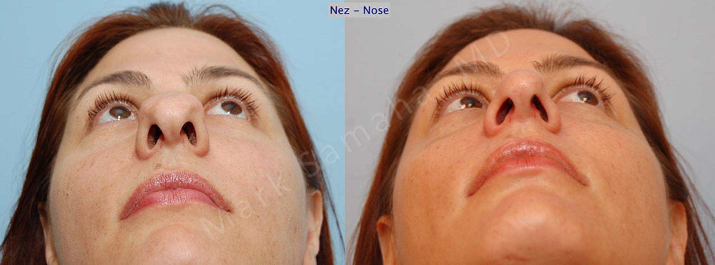 Before & After Rhinoplasty / Rhinoplastie Case 34 View #1 View in Mount Royal, QC