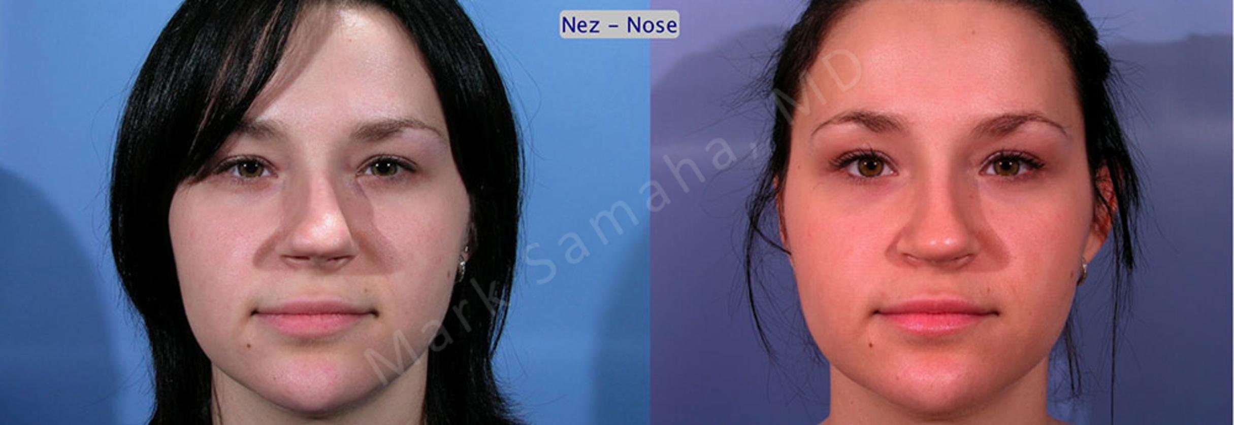 Before & After Rhinoplasty / Rhinoplastie Case 35 View #1 View in Mount Royal, QC