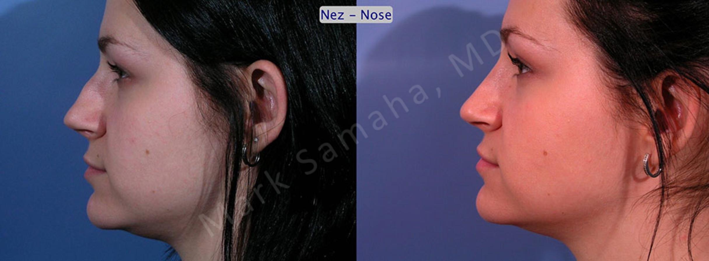 Before & After Rhinoplasty / Rhinoplastie Case 35 View #2 View in Mount Royal, QC