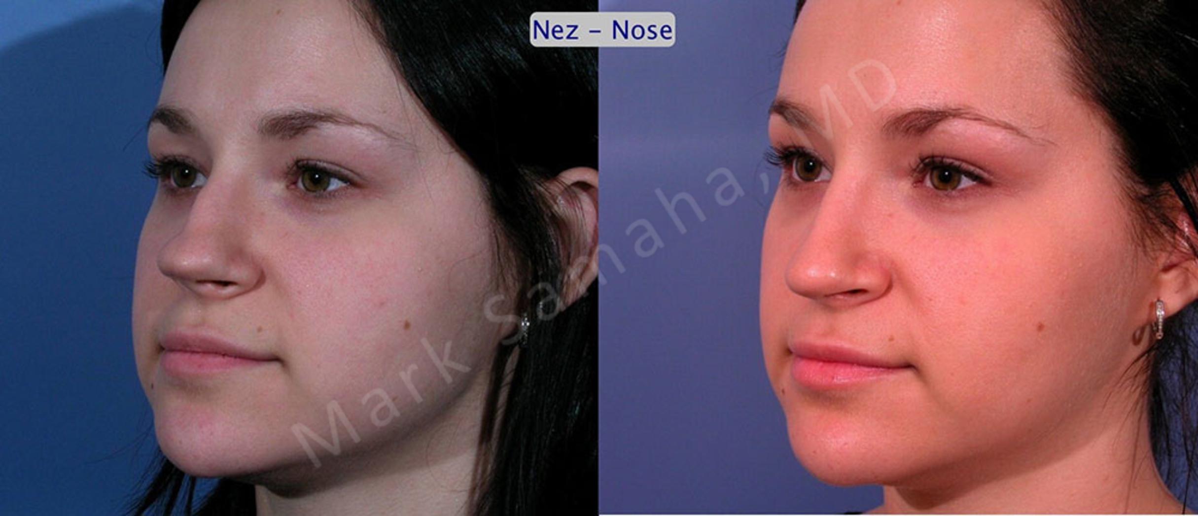 Before & After Rhinoplasty / Rhinoplastie Case 35 View #3 View in Mount Royal, QC