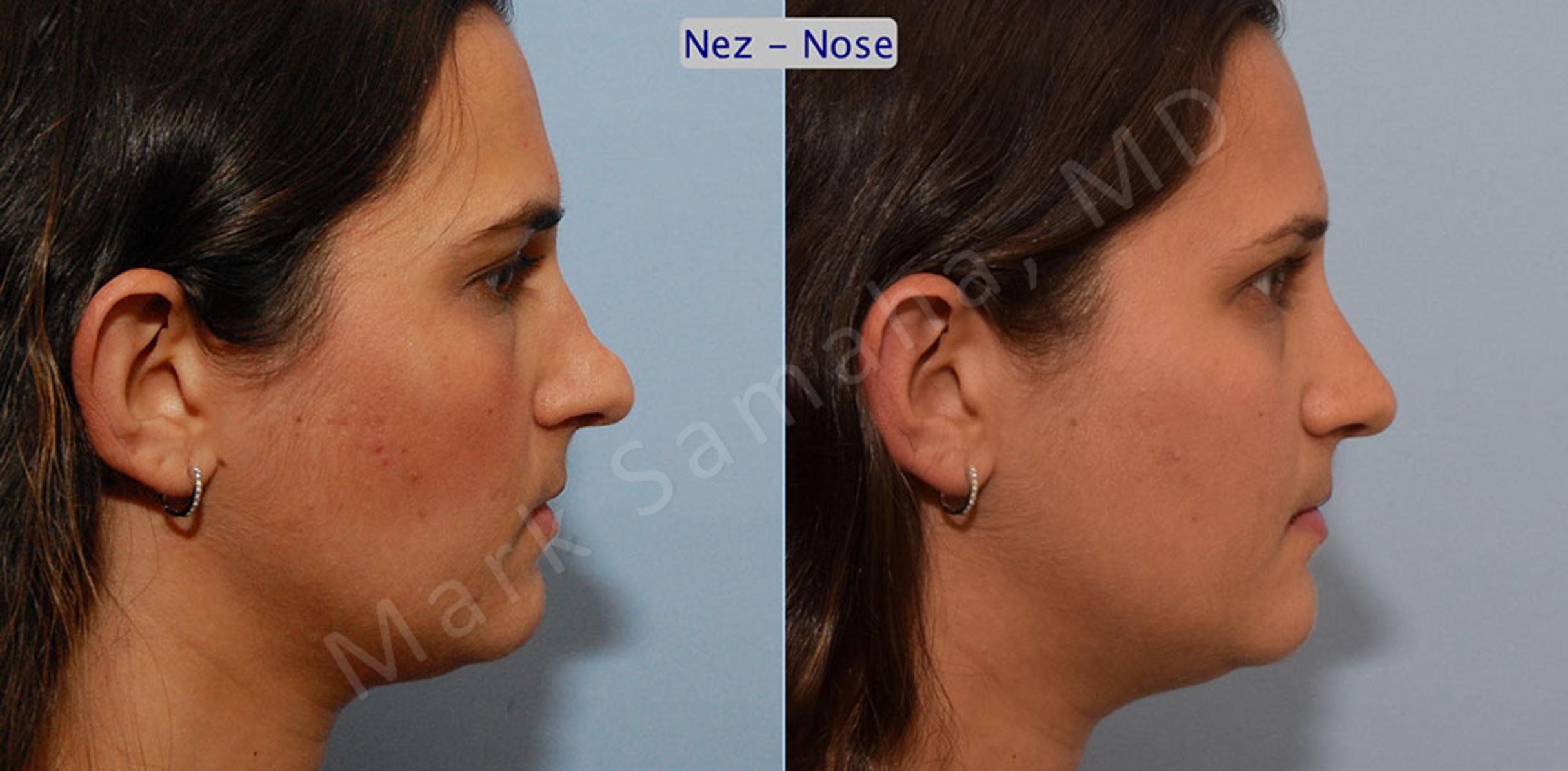 Before & After Rhinoplasty / Rhinoplastie Case 37 View #2 View in Mount Royal, QC