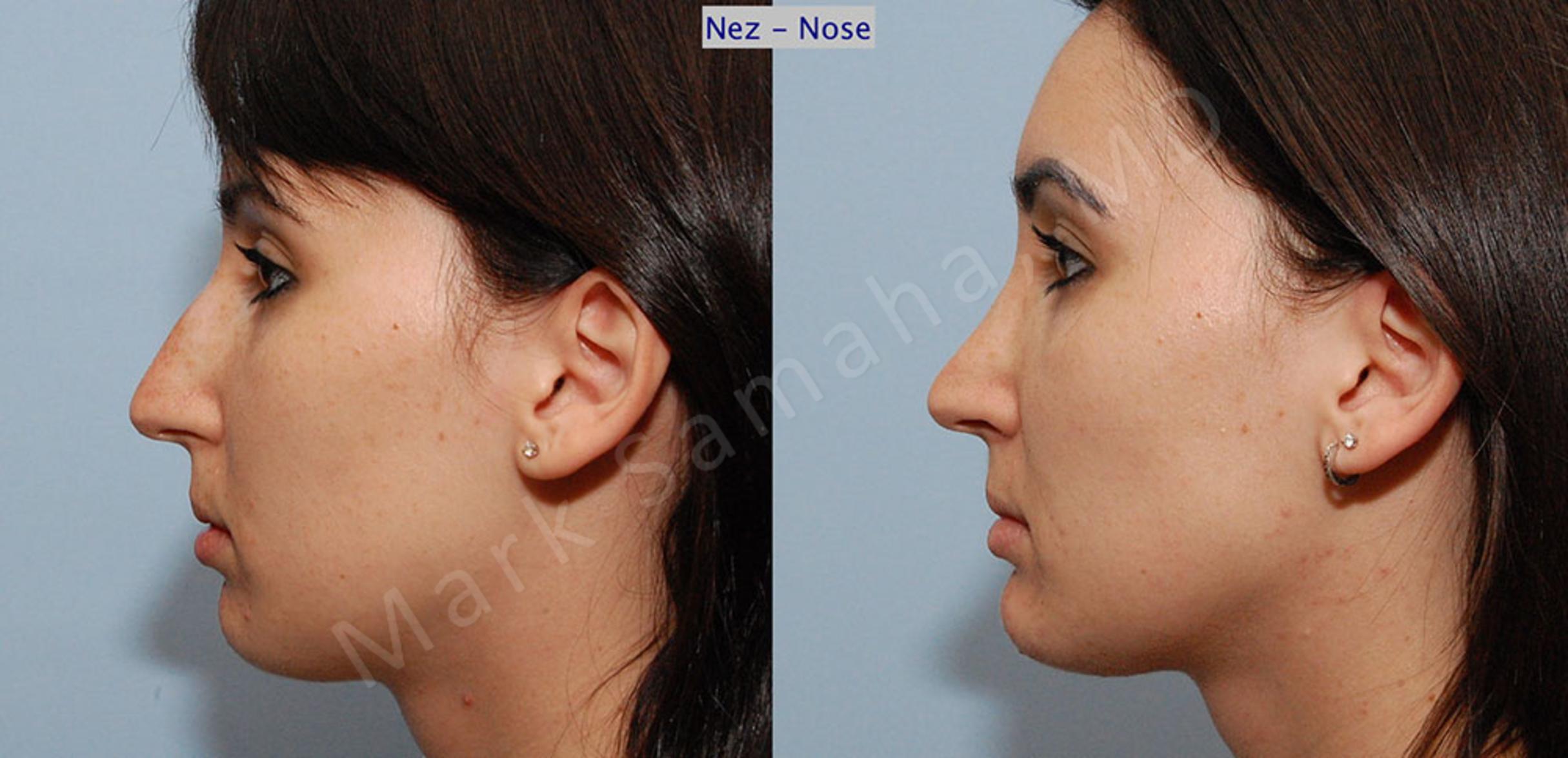 Before & After Rhinoplasty / Rhinoplastie Case 38 View #2 View in Mount Royal, QC