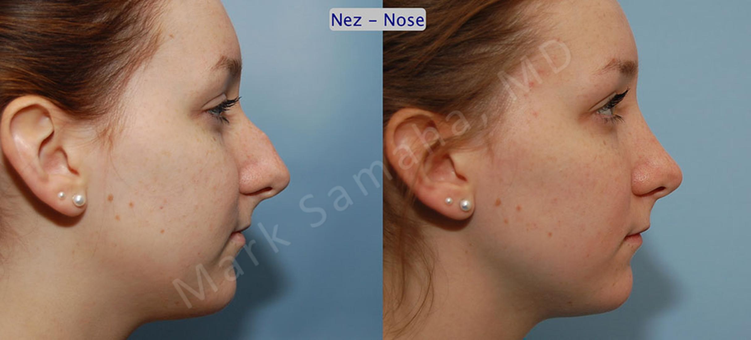 Before & After Rhinoplasty / Rhinoplastie Case 39 View #2 View in Mount Royal, QC