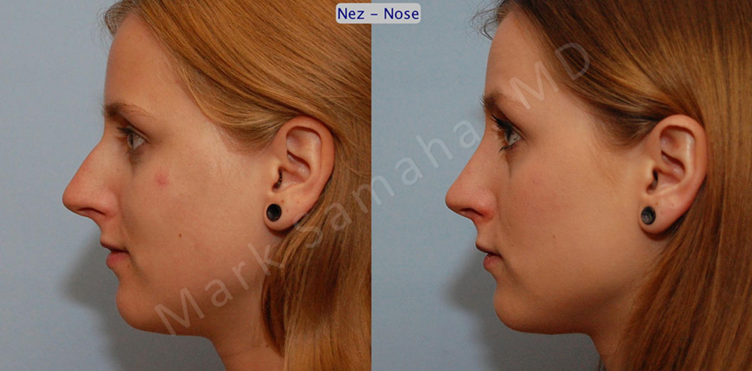 Before & After Rhinoplasty / Rhinoplastie Case 40 View #1 View in Mount Royal, QC