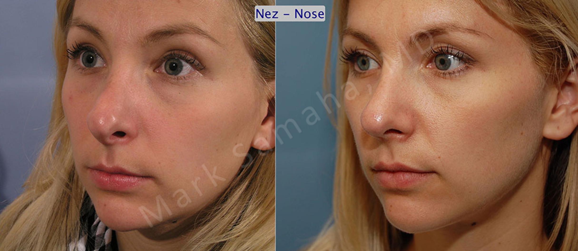 Before & After Rhinoplasty / Rhinoplastie Case 41 View #2 View in Mount Royal, QC