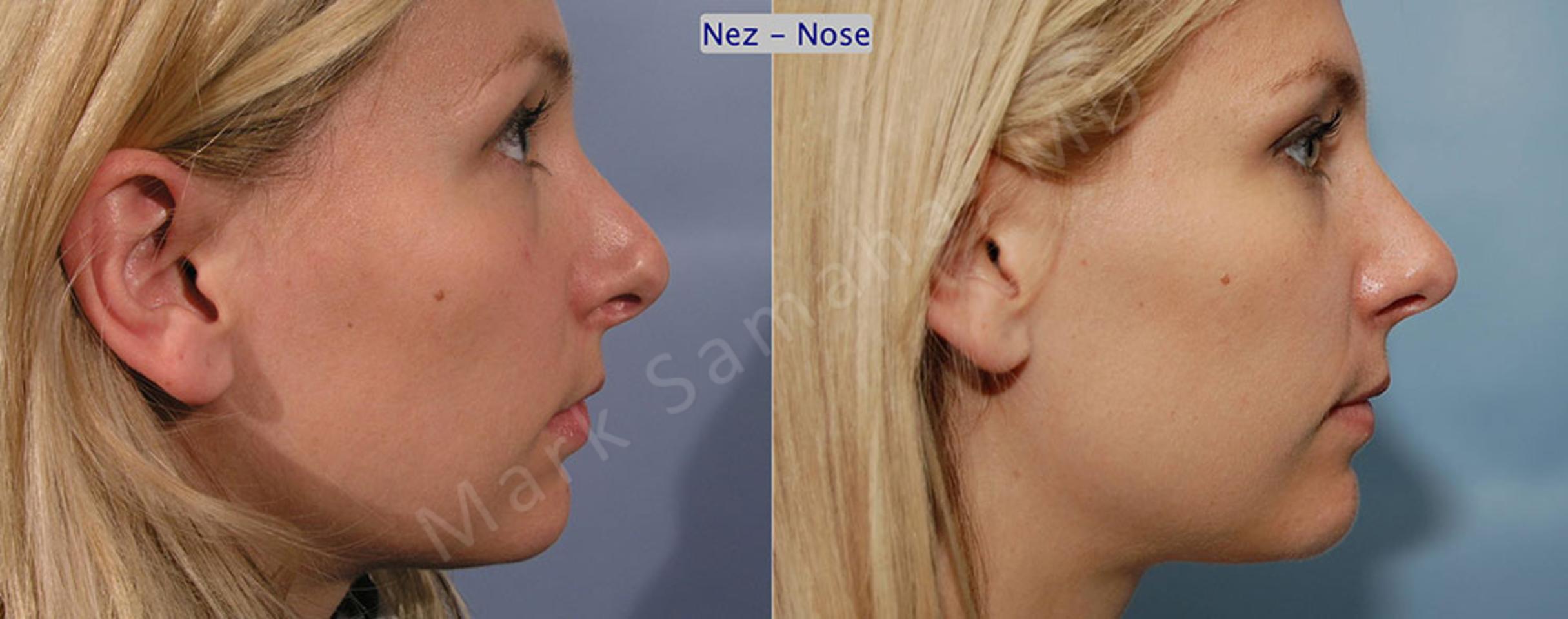 Before & After Rhinoplasty / Rhinoplastie Case 41 View #4 View in Mount Royal, QC