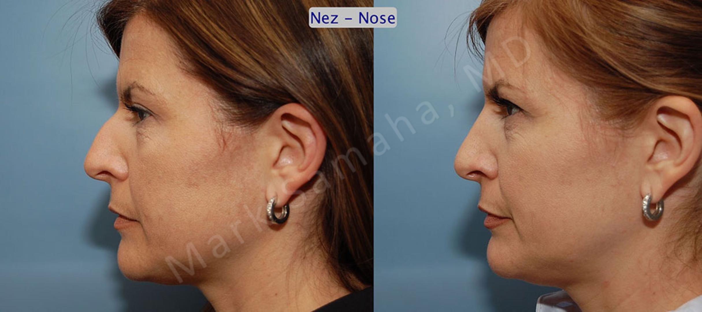 Before & After Rhinoplasty / Rhinoplastie Case 42 View #1 View in Mount Royal, QC