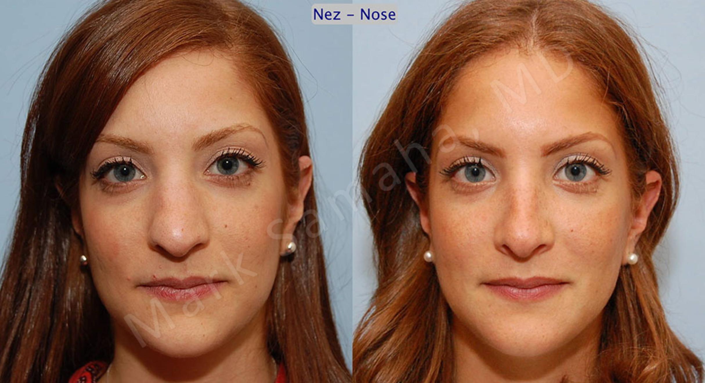 Before & After Rhinoplasty / Rhinoplastie Case 43 View #1 View in Mount Royal, QC