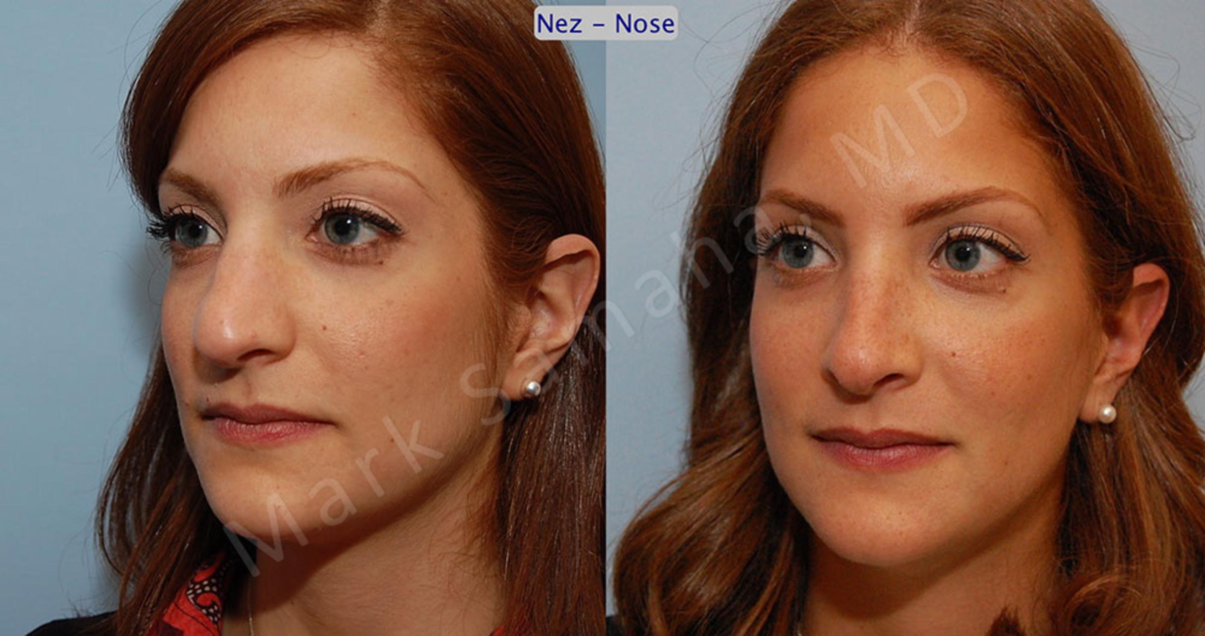 Before & After Rhinoplastie / Rhinoplasty Case 43 View #3 View in Mount Royal, QC