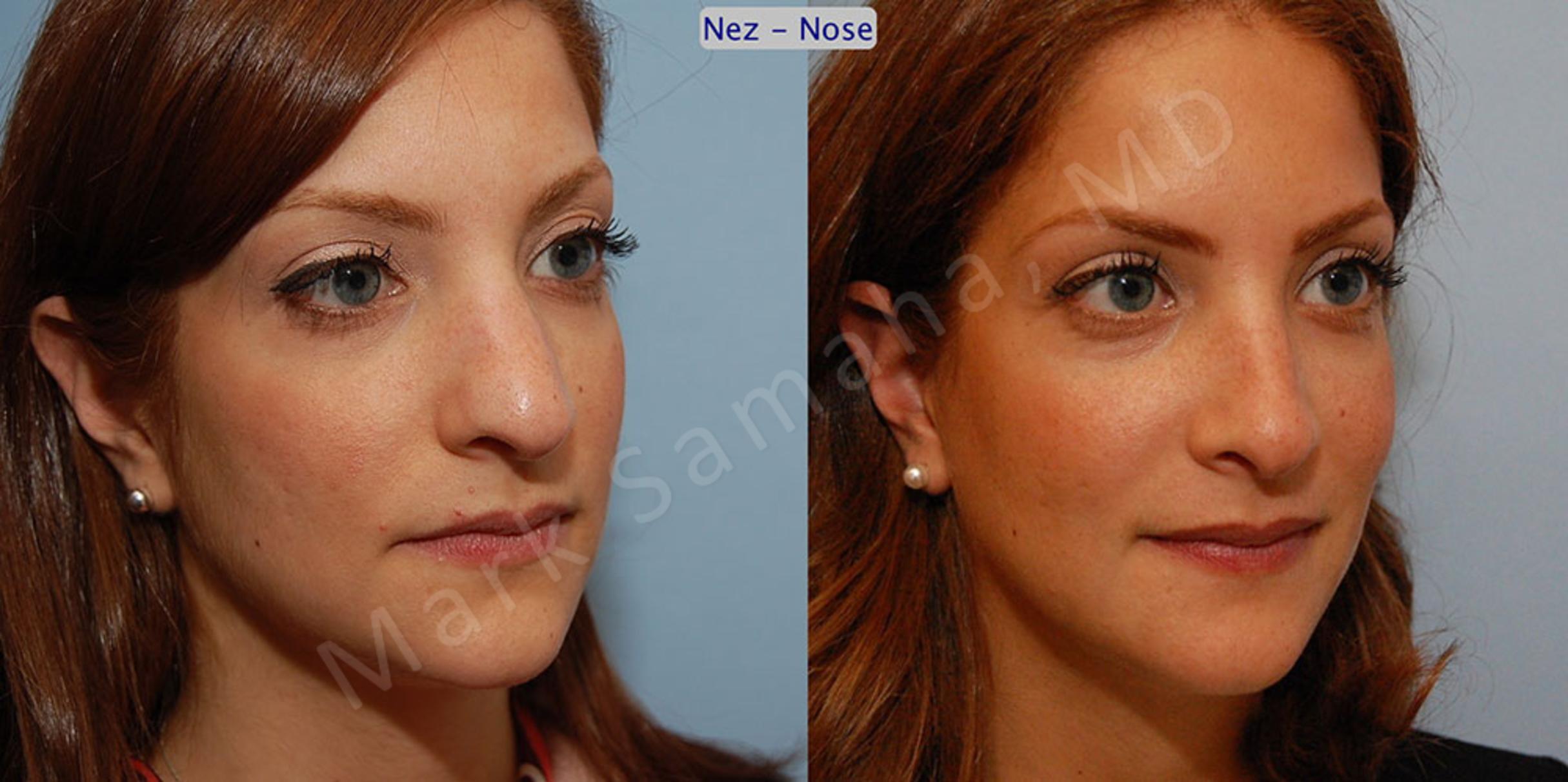 Before & After Rhinoplastie / Rhinoplasty Case 43 View #4 View in Mount Royal, QC