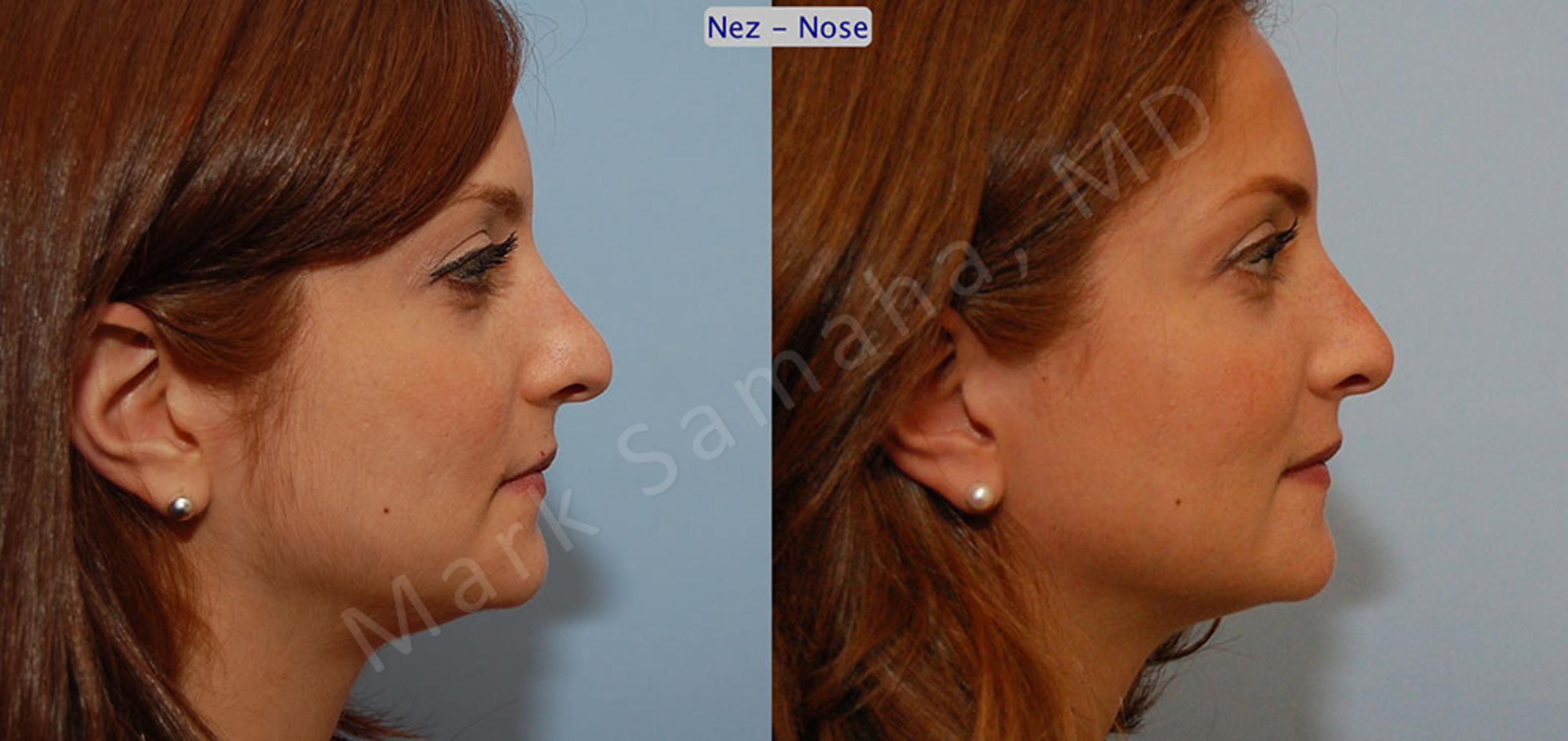 Before & After Rhinoplasty / Rhinoplastie Case 43 View #5 View in Mount Royal, QC