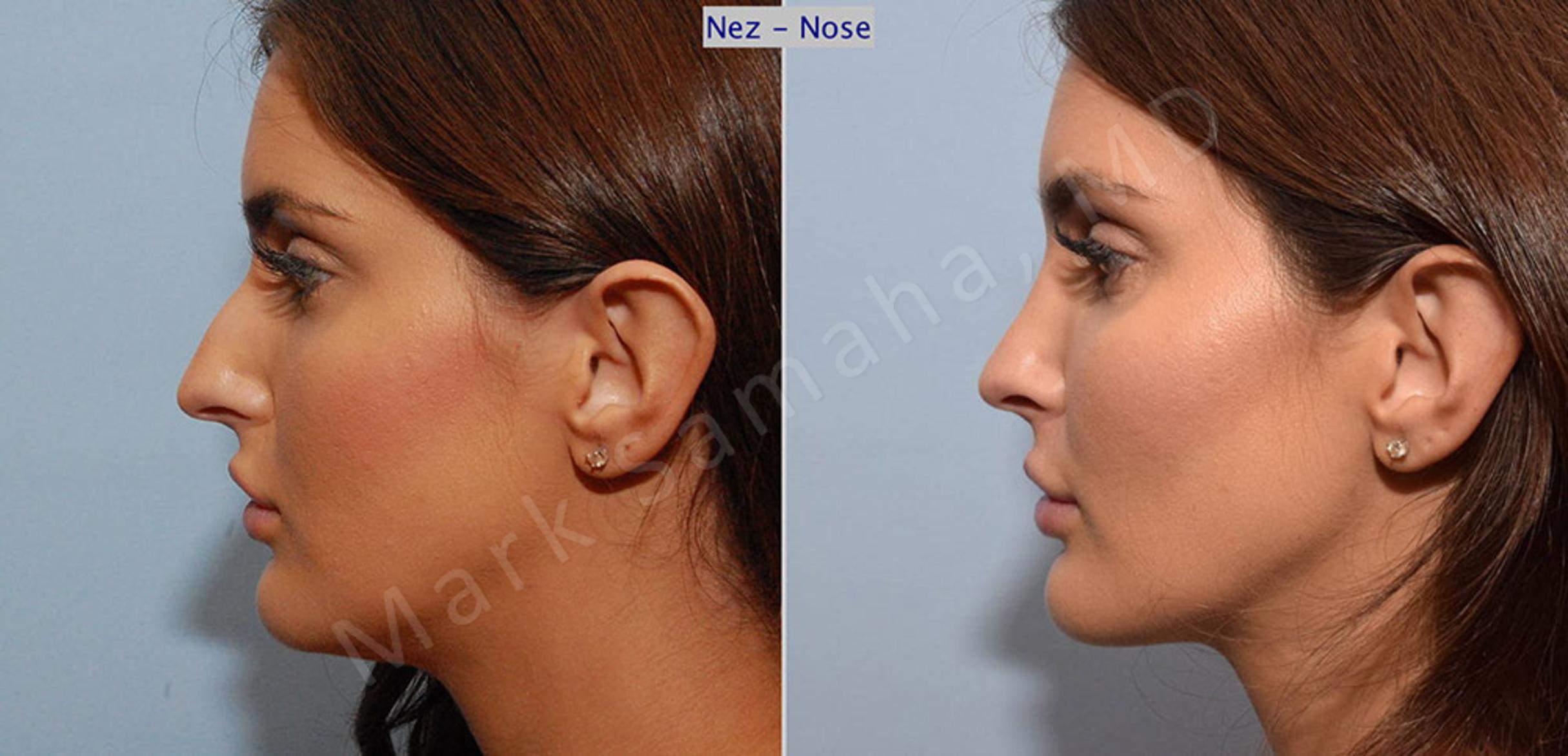 Before & After Rhinoplasty / Rhinoplastie Case 45 View #1 View in Mount Royal, QC