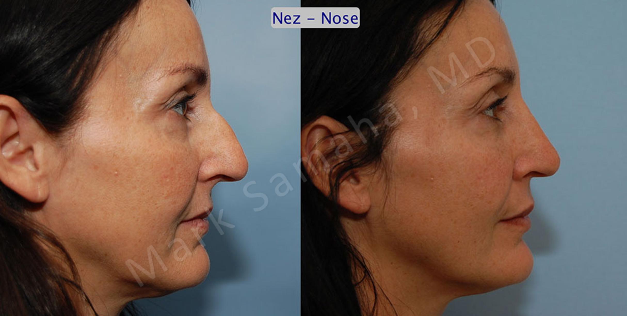 Before & After Rhinoplastie / Rhinoplasty Case 46 View #5 View in Mount Royal, QC