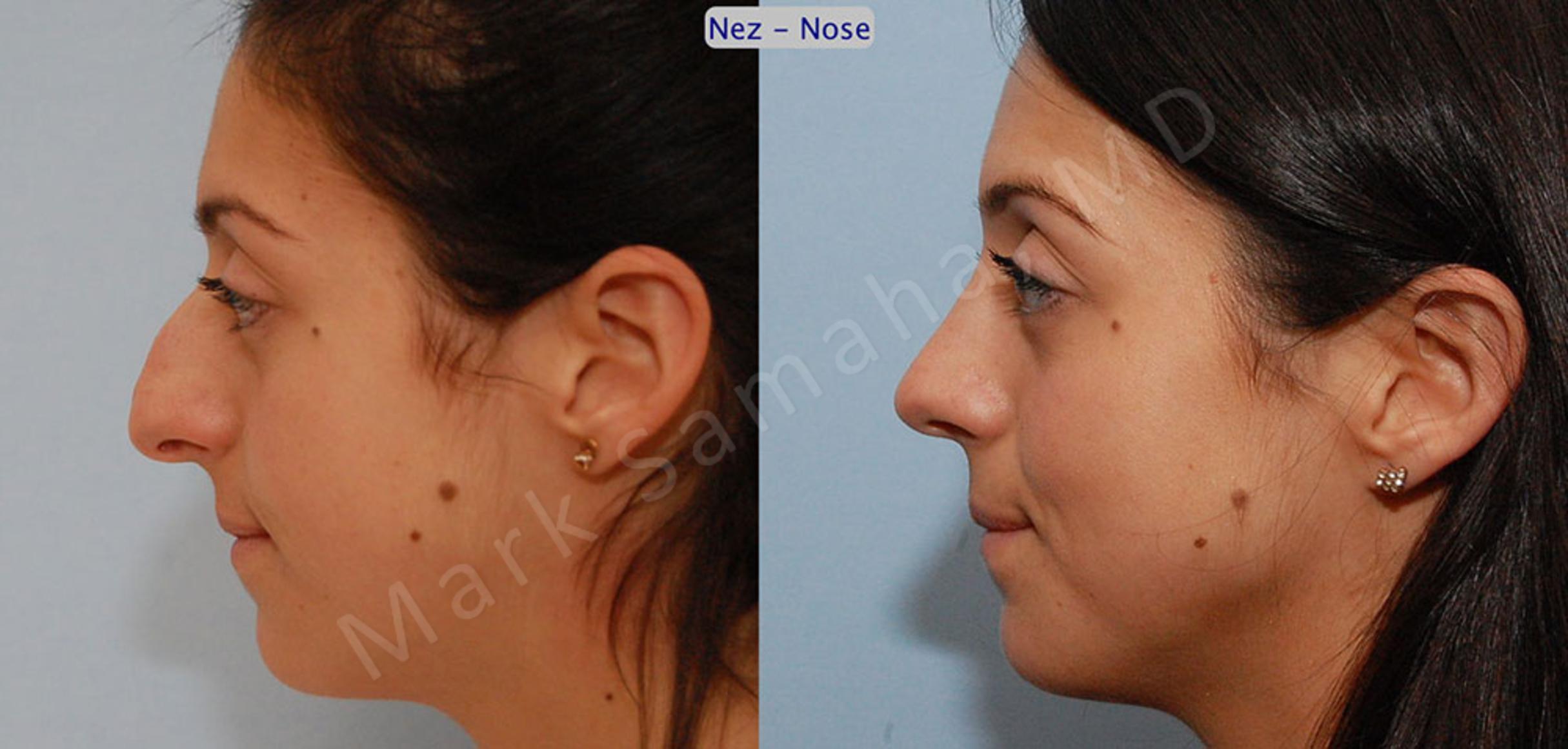 Before & After Rhinoplasty / Rhinoplastie Case 47 View #2 View in Mount Royal, QC