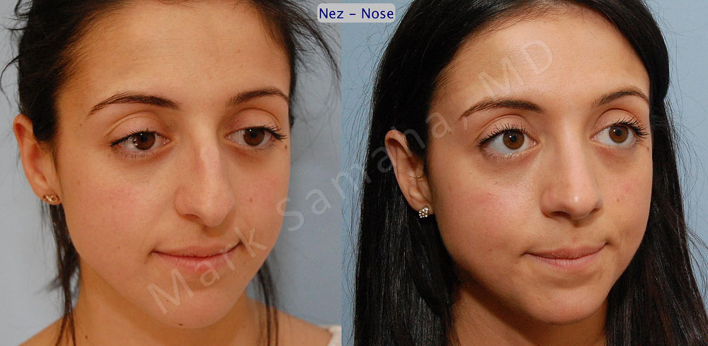 Before & After Rhinoplasty / Rhinoplastie Case 47 View #4 View in Mount Royal, QC