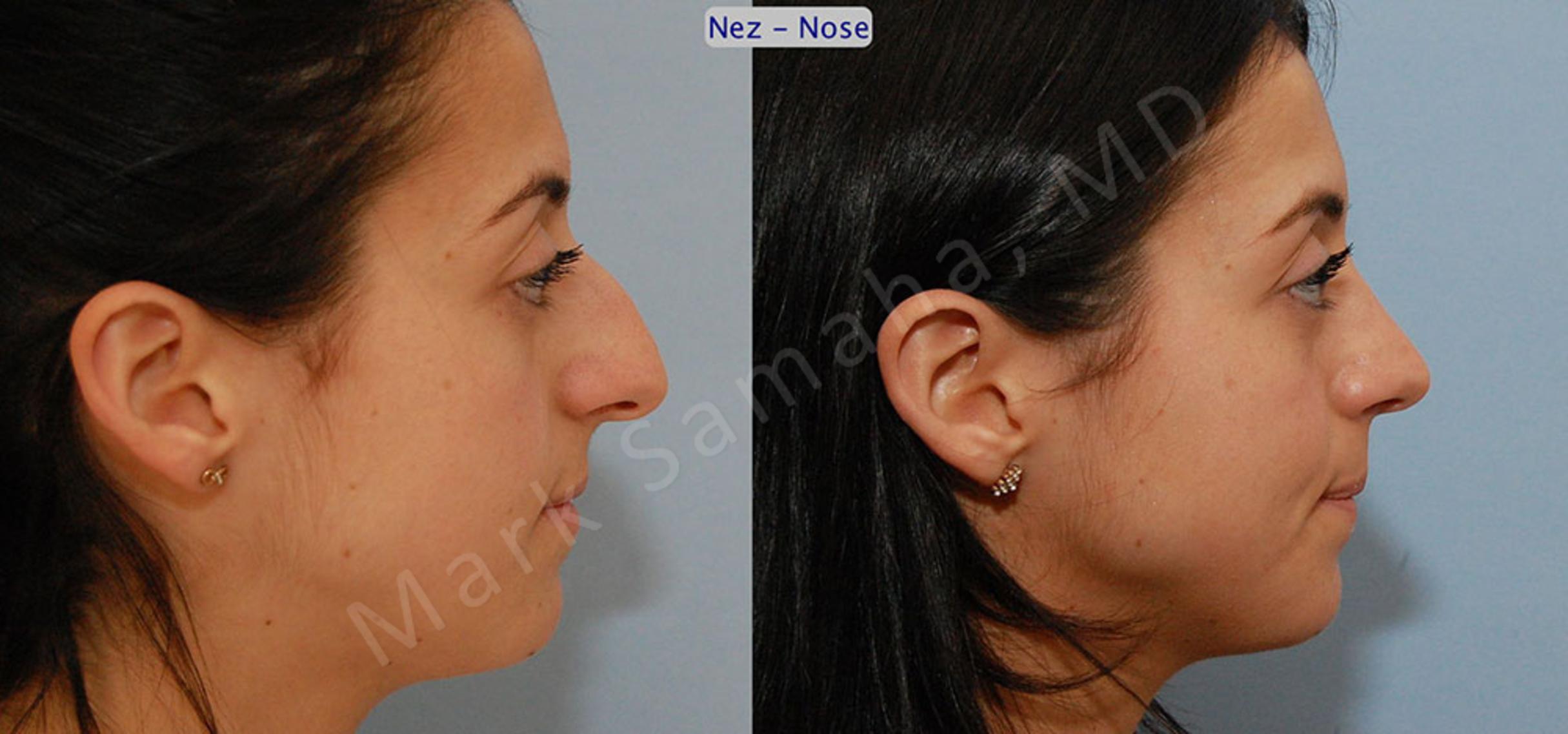 Before & After Rhinoplasty / Rhinoplastie Case 47 View #5 View in Mount Royal, QC