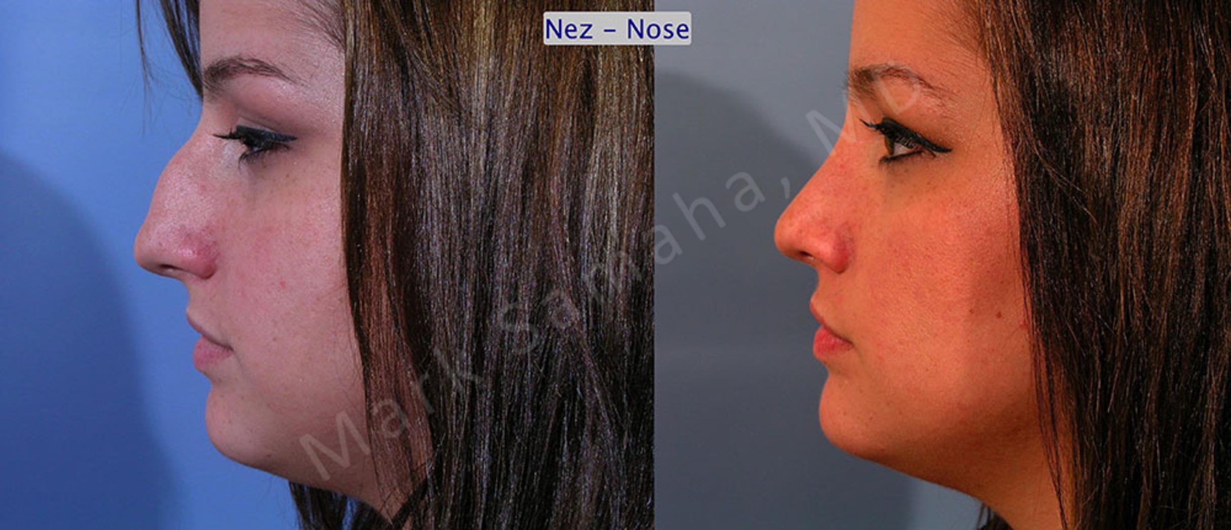 Before & After Rhinoplastie / Rhinoplasty Case 48 View #2 View in Mount Royal, QC