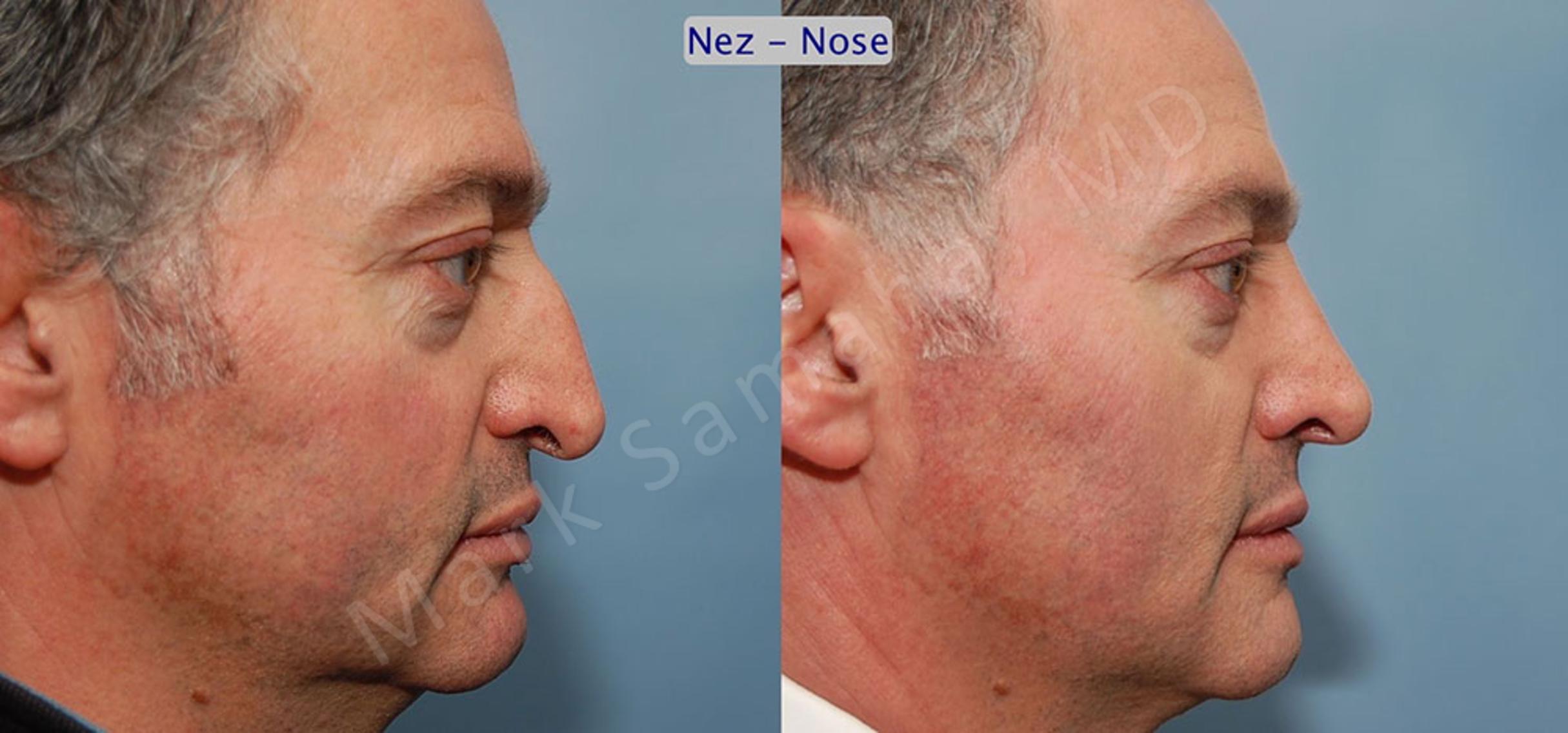 Before & After Rhinoplasty / Rhinoplastie Case 49 View #2 View in Mount Royal, QC