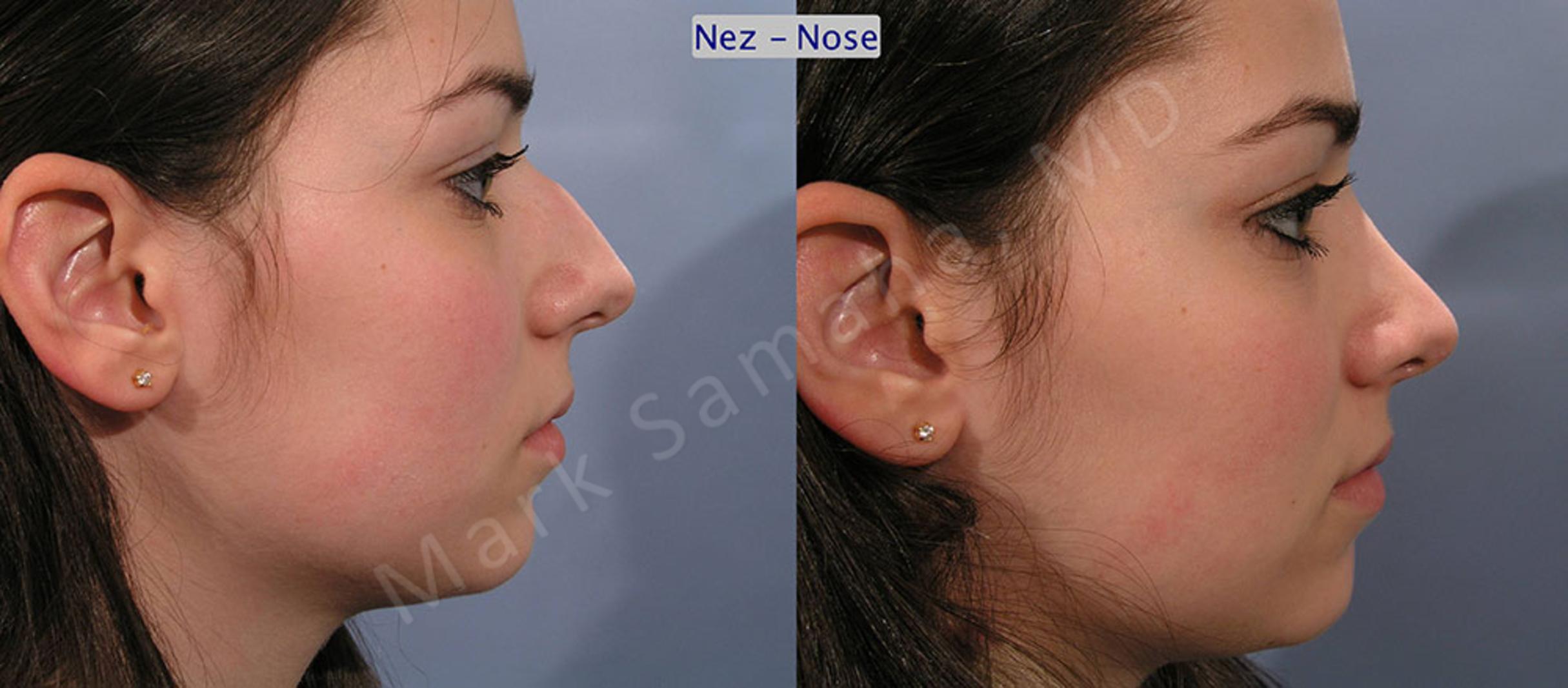 Before & After Rhinoplasty / Rhinoplastie Case 52 View #2 View in Mount Royal, QC