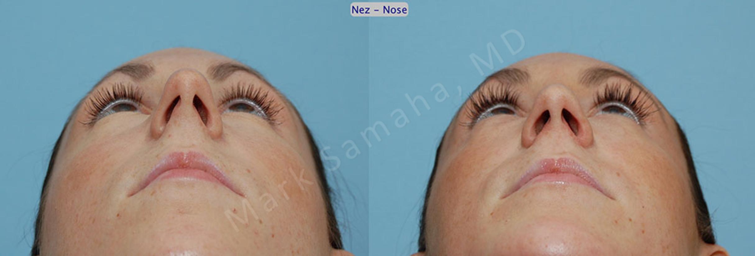Before & After Rhinoplastie / Rhinoplasty Case 53 View #1 View in Mount Royal, QC