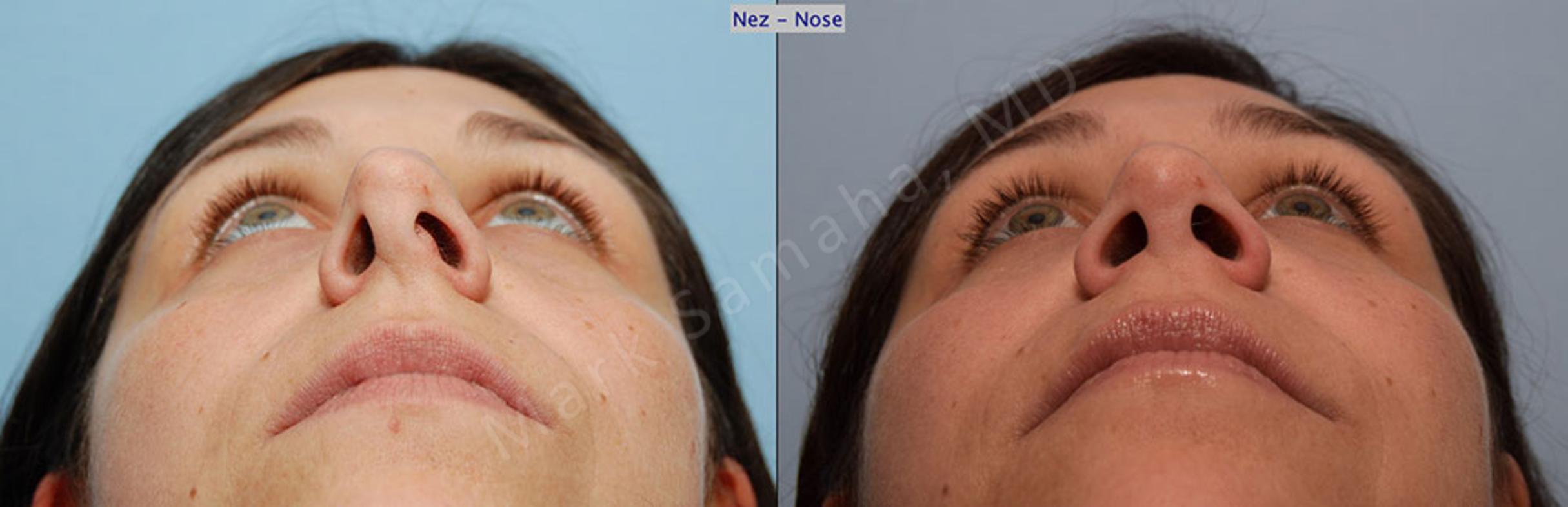 Before & After Rhinoplastie / Rhinoplasty Case 54 View #1 View in Mount Royal, QC