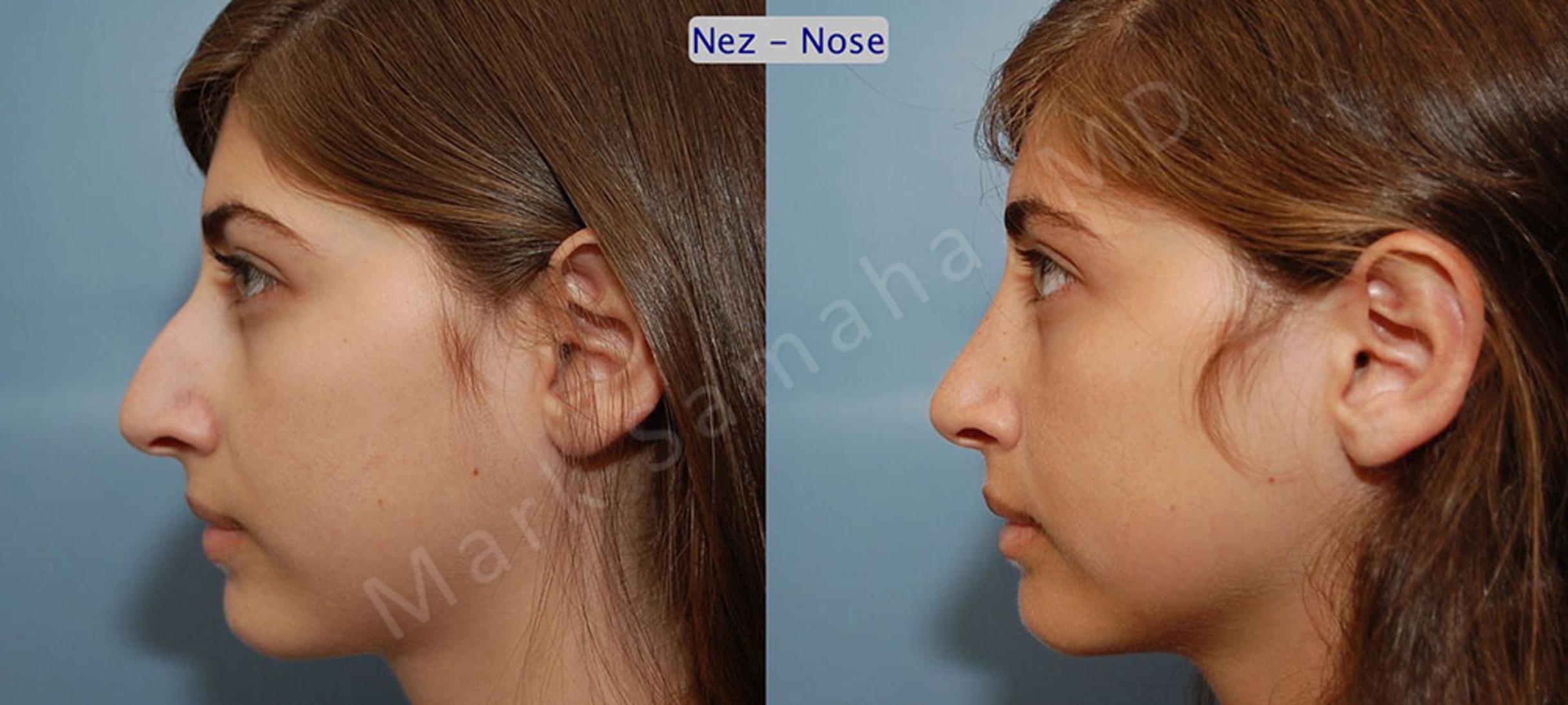 Before & After Rhinoplastie / Rhinoplasty Case 55 View #2 View in Mount Royal, QC
