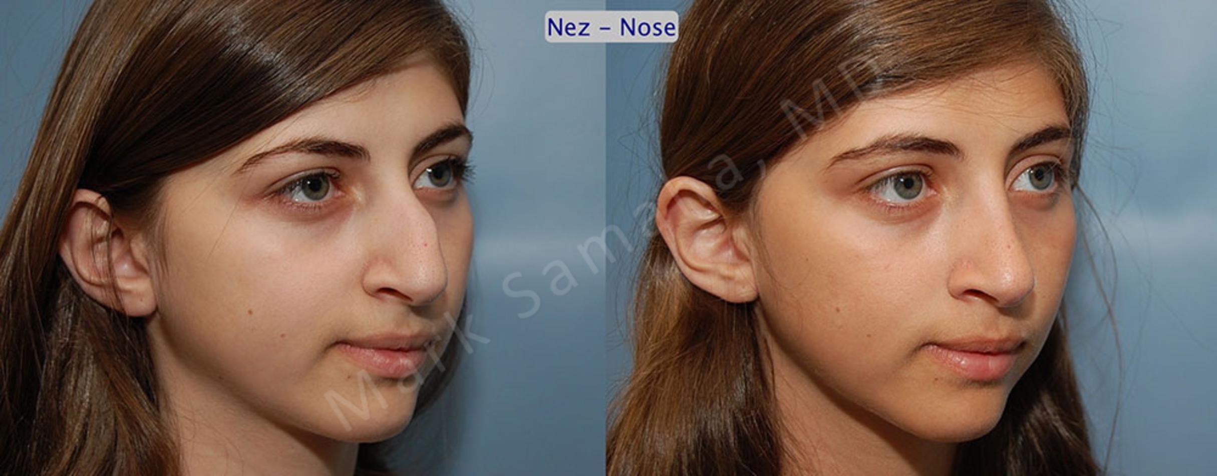 Before & After Rhinoplasty / Rhinoplastie Case 55 View #3 View in Mount Royal, QC