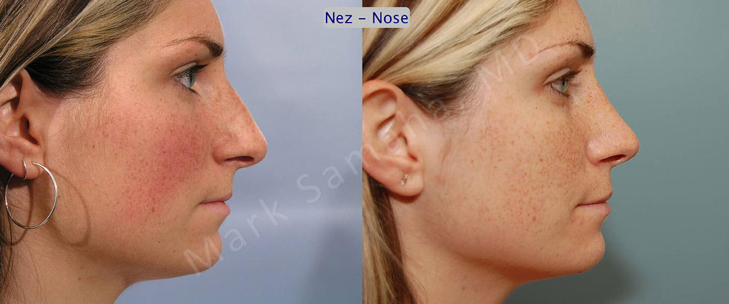 Before & After Rhinoplasty / Rhinoplastie Case 56 View #2 View in Mount Royal, QC
