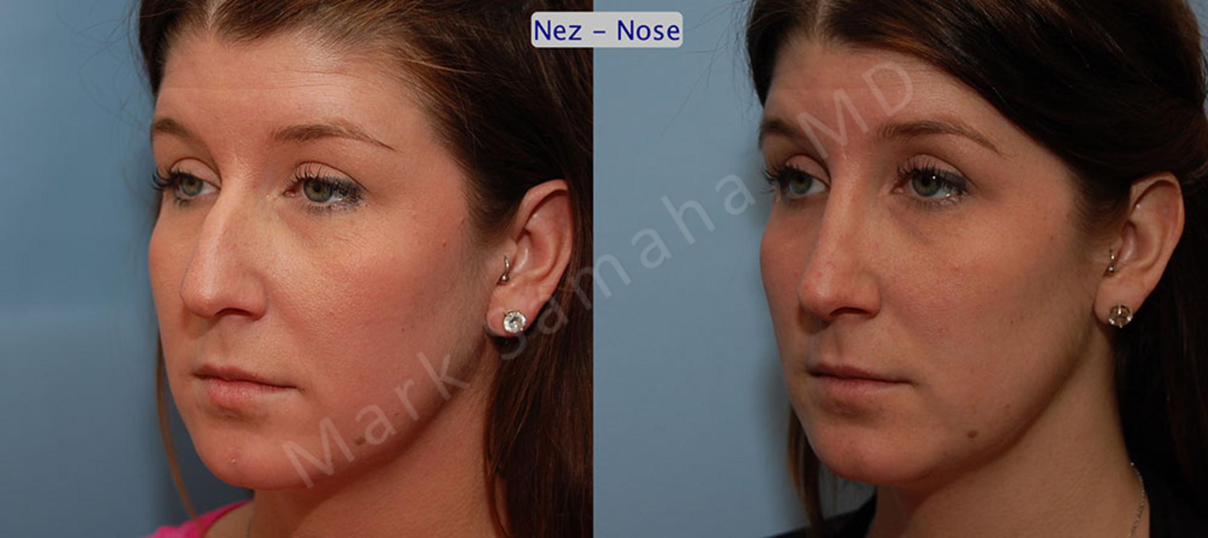 Before & After Rhinoplastie / Rhinoplasty Case 57 View #2 View in Mount Royal, QC