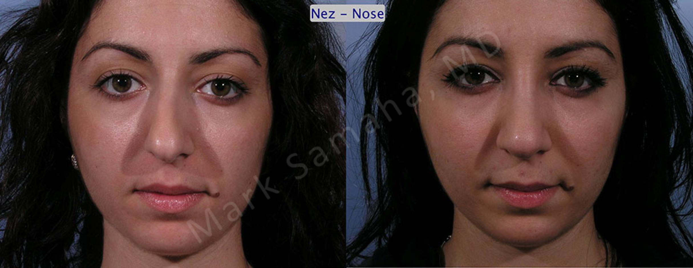 Before & After Rhinoplasty / Rhinoplastie Case 58 View #2 View in Mount Royal, QC