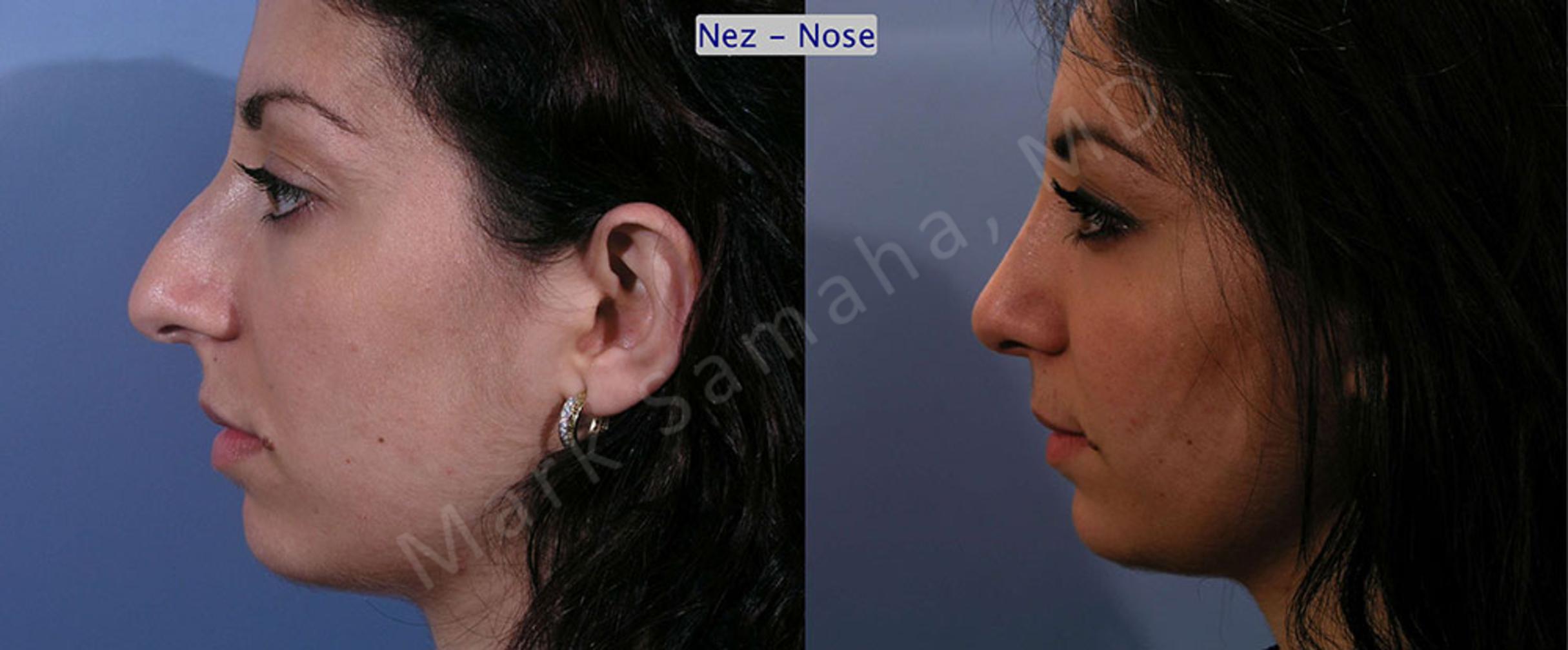 Before & After Rhinoplasty / Rhinoplastie Case 58 View #3 View in Mount Royal, QC