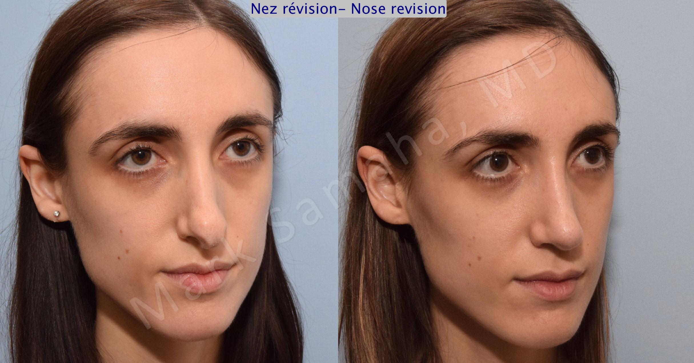 Before & After Rhinoplasty / Rhinoplastie Case 75 View #5 View in Mount Royal, QC