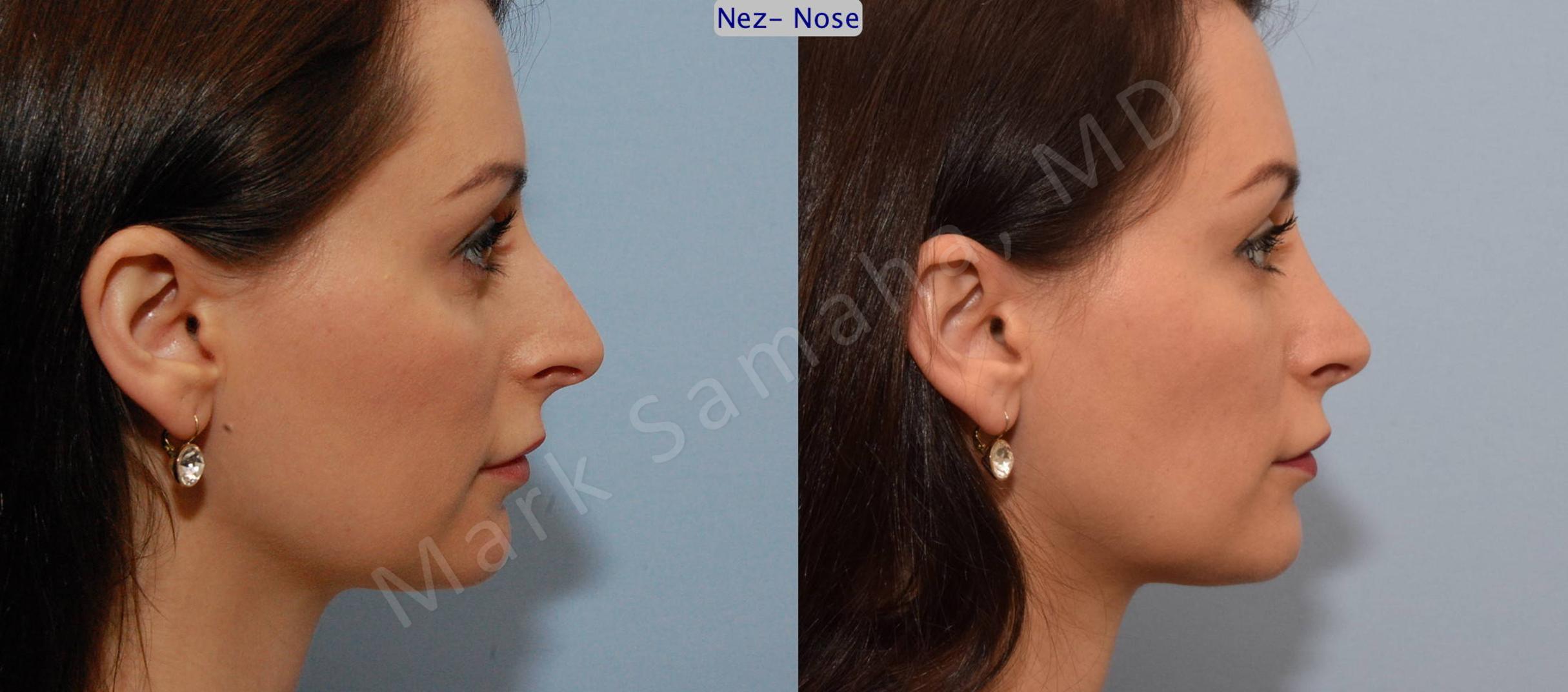 Before & After Rhinoplasty / Rhinoplastie Case 76 View #2 View in Mount Royal, QC