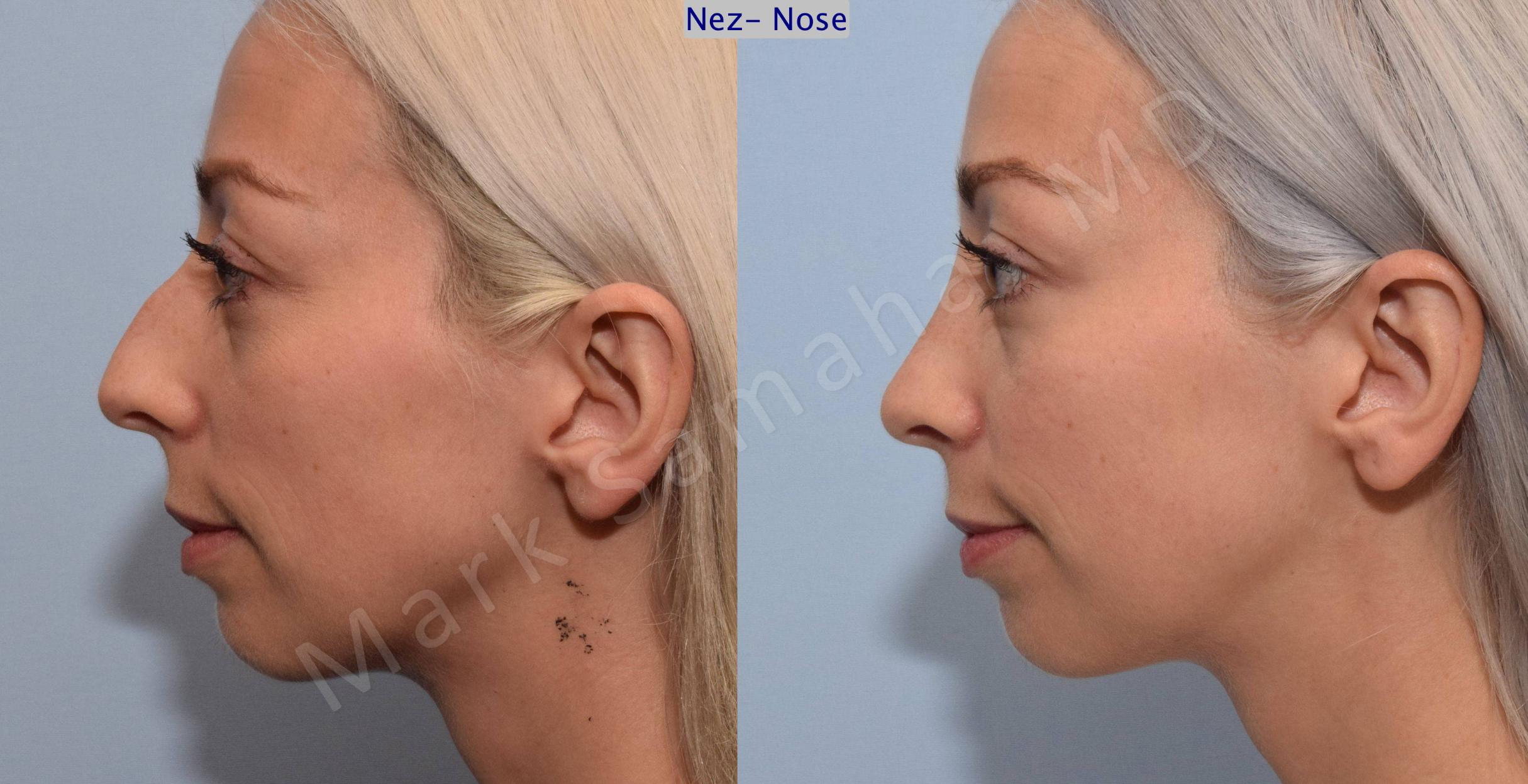Before & After Rhinoplasty / Rhinoplastie Case 77 View #1 View in Mount Royal, QC