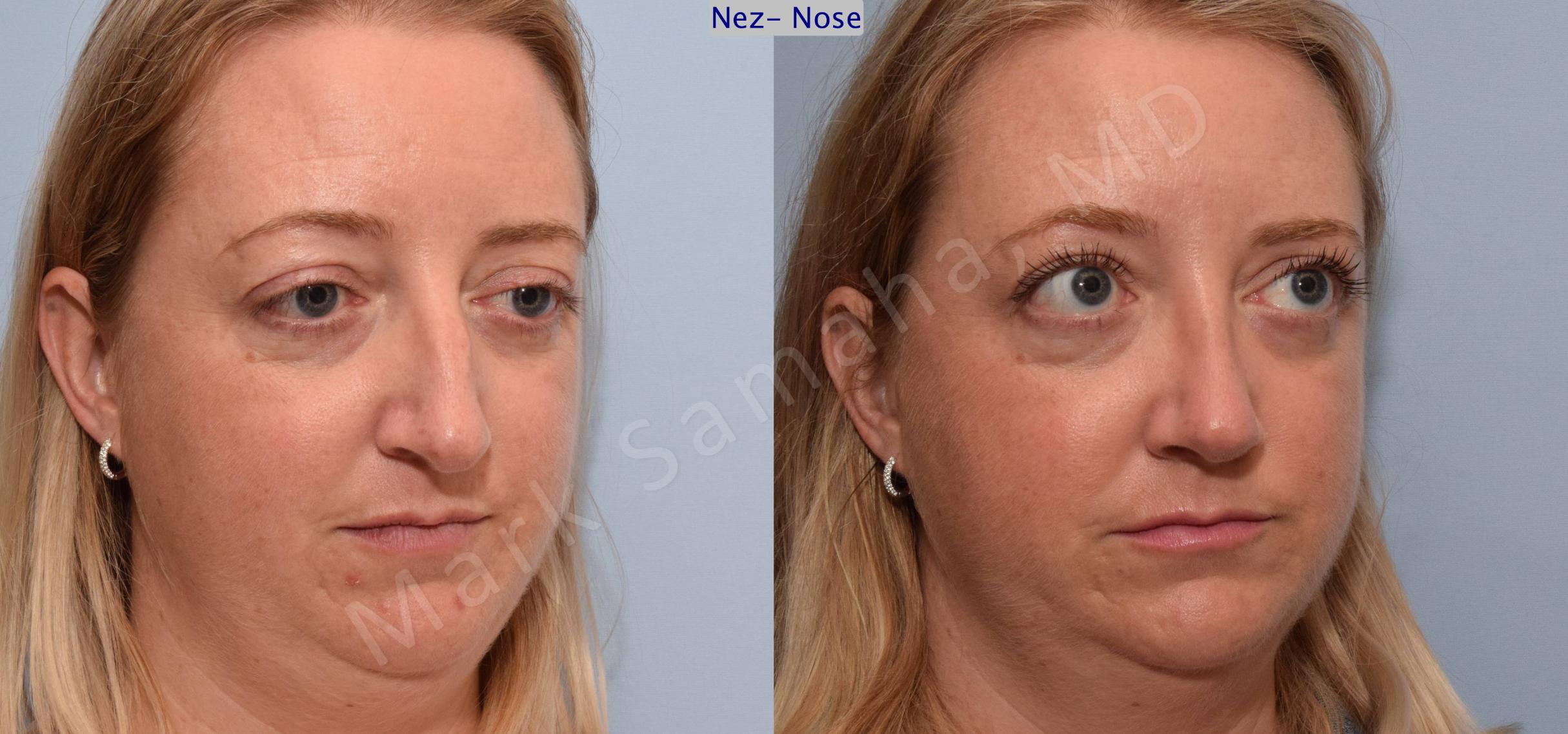 Before & After Rhinoplasty / Rhinoplastie Case 78 View #3 View in Mount Royal, QC