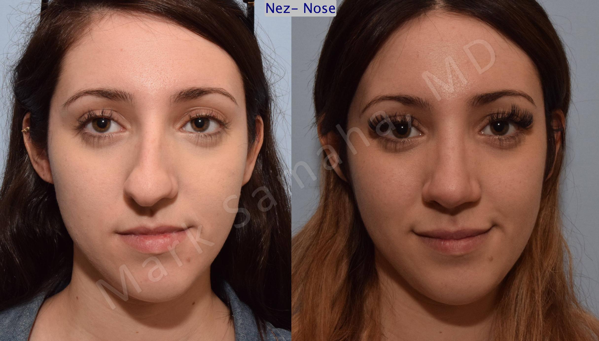 Before & After Rhinoplasty / Rhinoplastie Case 79 View #1 View in Mount Royal, QC