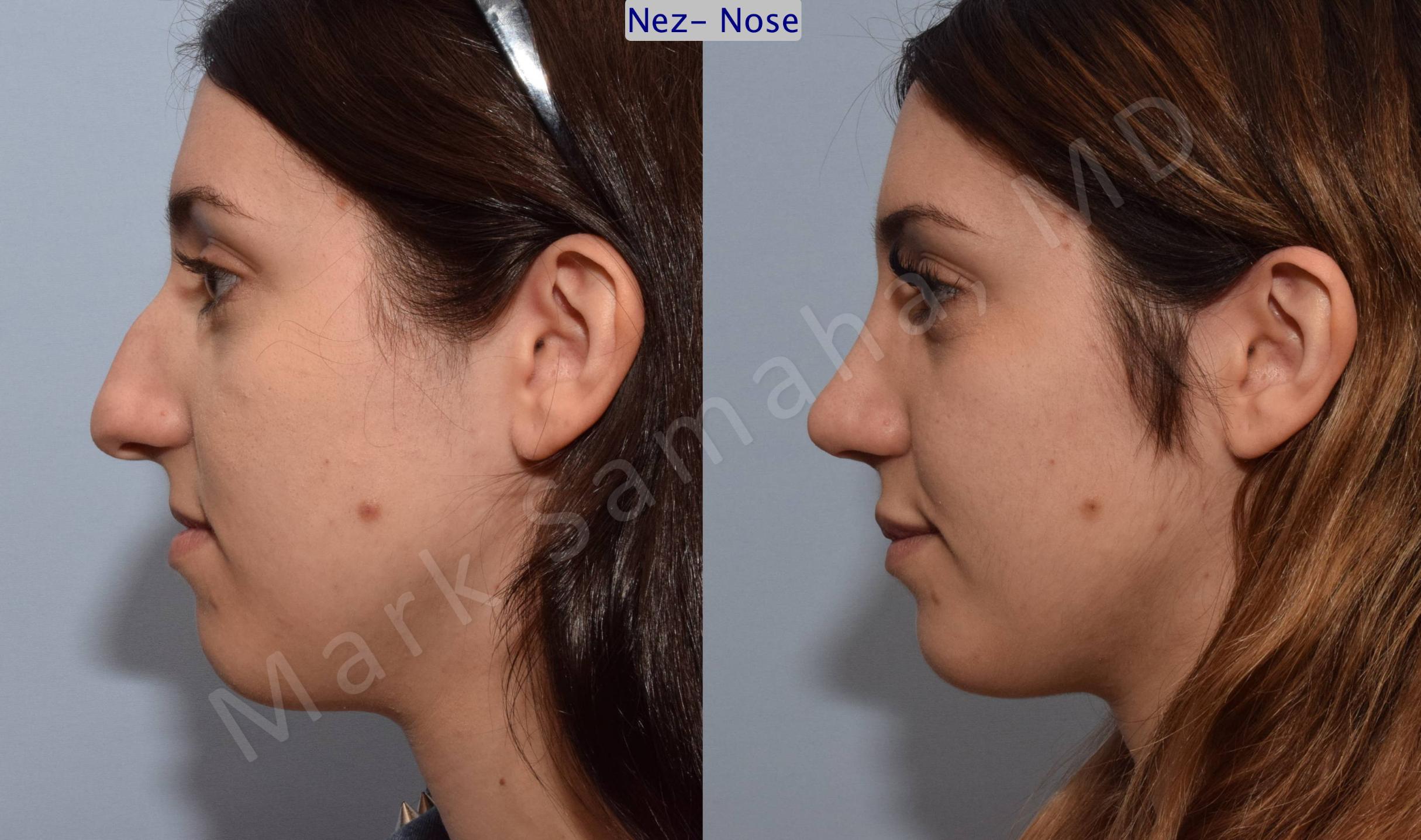 Before & After Rhinoplasty / Rhinoplastie Case 79 View #2 View in Mount Royal, QC