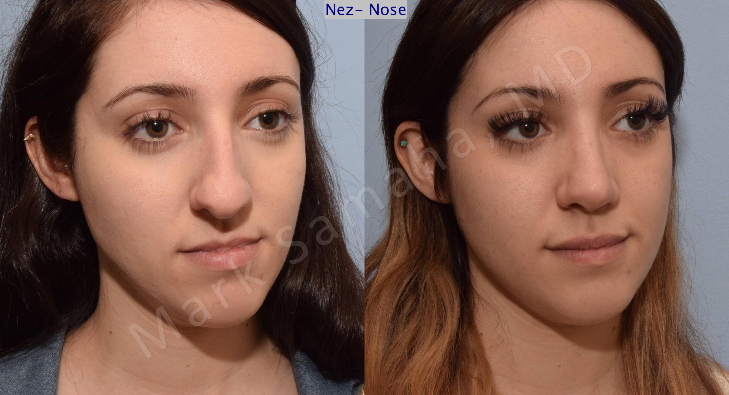 Before & After Rhinoplasty / Rhinoplastie Case 79 View #5 View in Mount Royal, QC