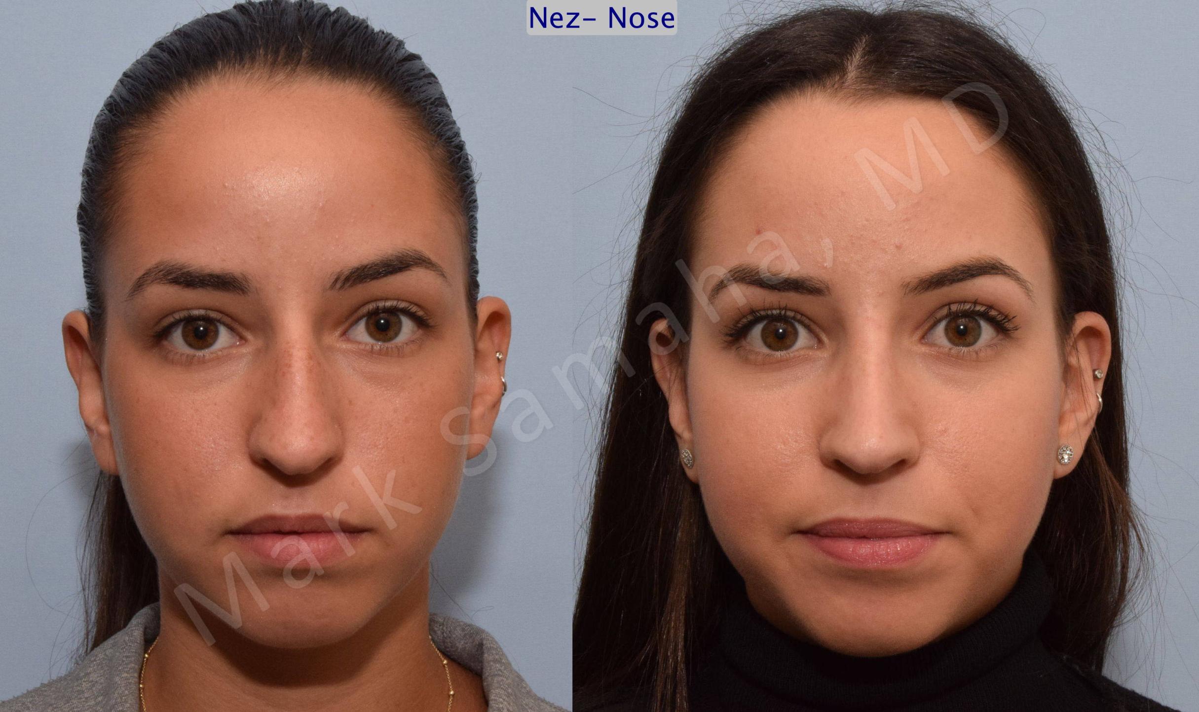 Before & After Rhinoplastie / Rhinoplasty Case 80 View #1 View in Mount Royal, QC