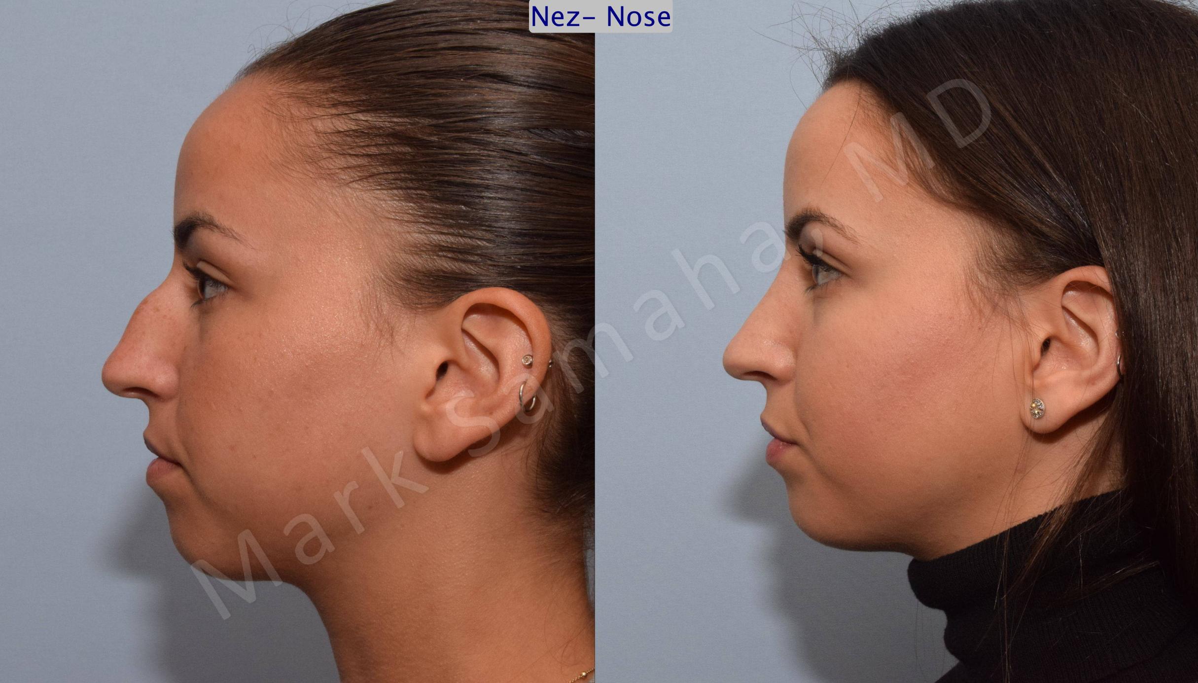 Before & After Rhinoplasty / Rhinoplastie Case 80 View #2 View in Mount Royal, QC