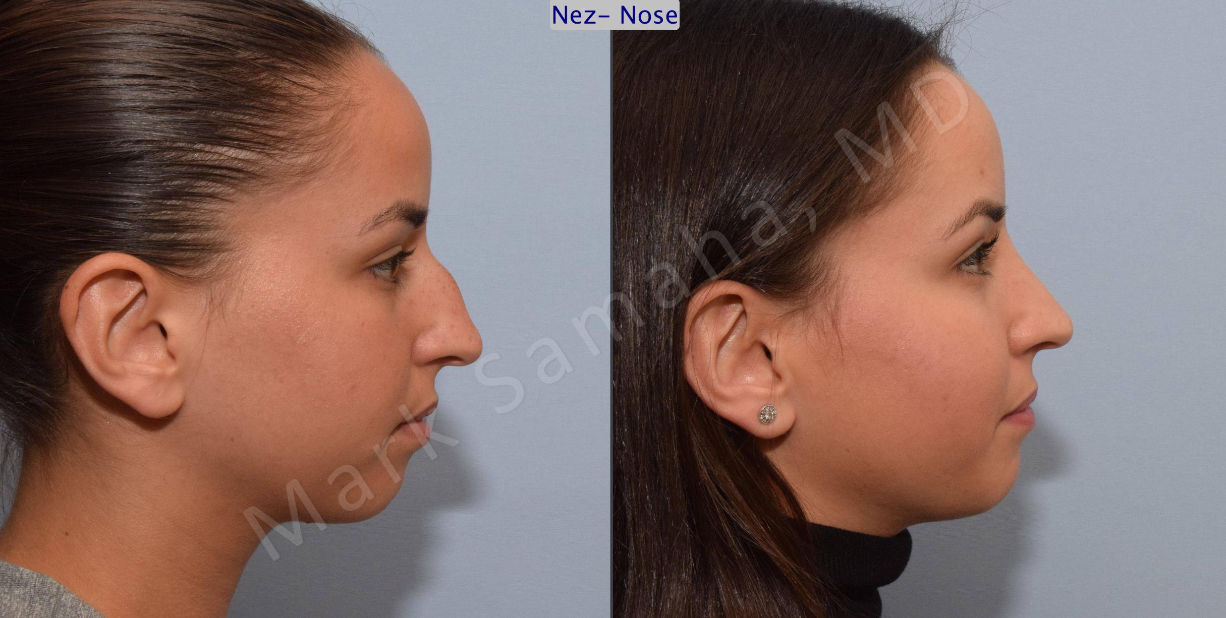 Before & After Rhinoplasty / Rhinoplastie Case 80 View #3 View in Mount Royal, QC