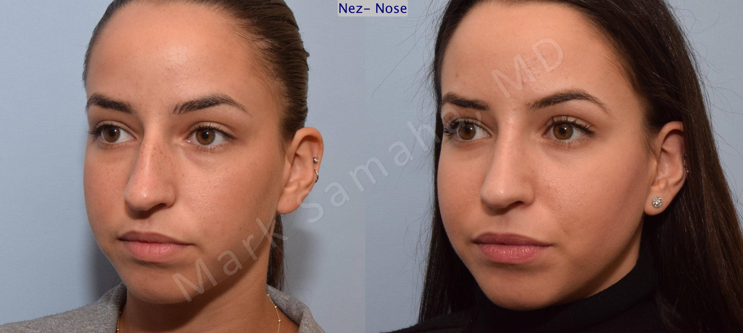 Before & After Rhinoplastie / Rhinoplasty Case 80 View #4 View in Mount Royal, QC