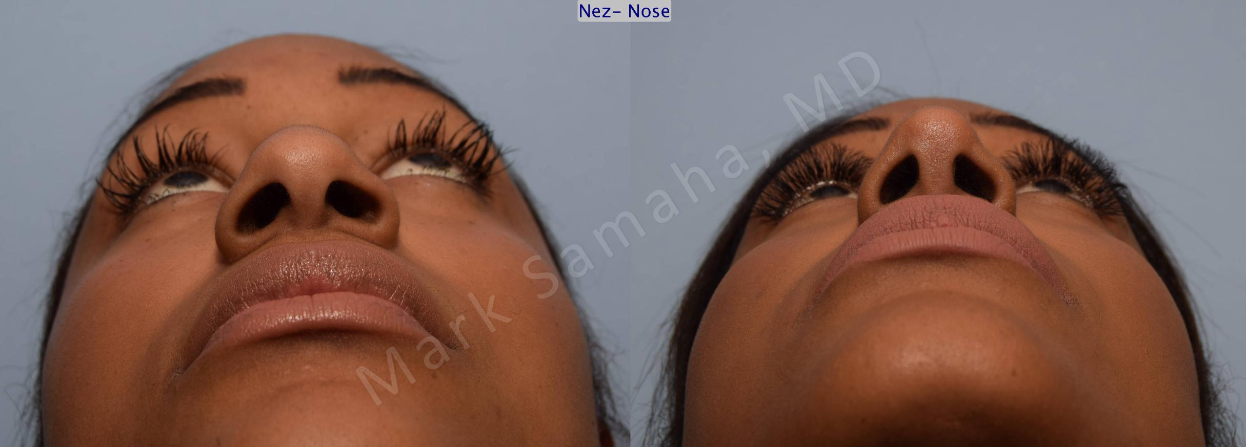 Before & After Rhinoplasty / Rhinoplastie Case 81 View #2 View in Mount Royal, QC