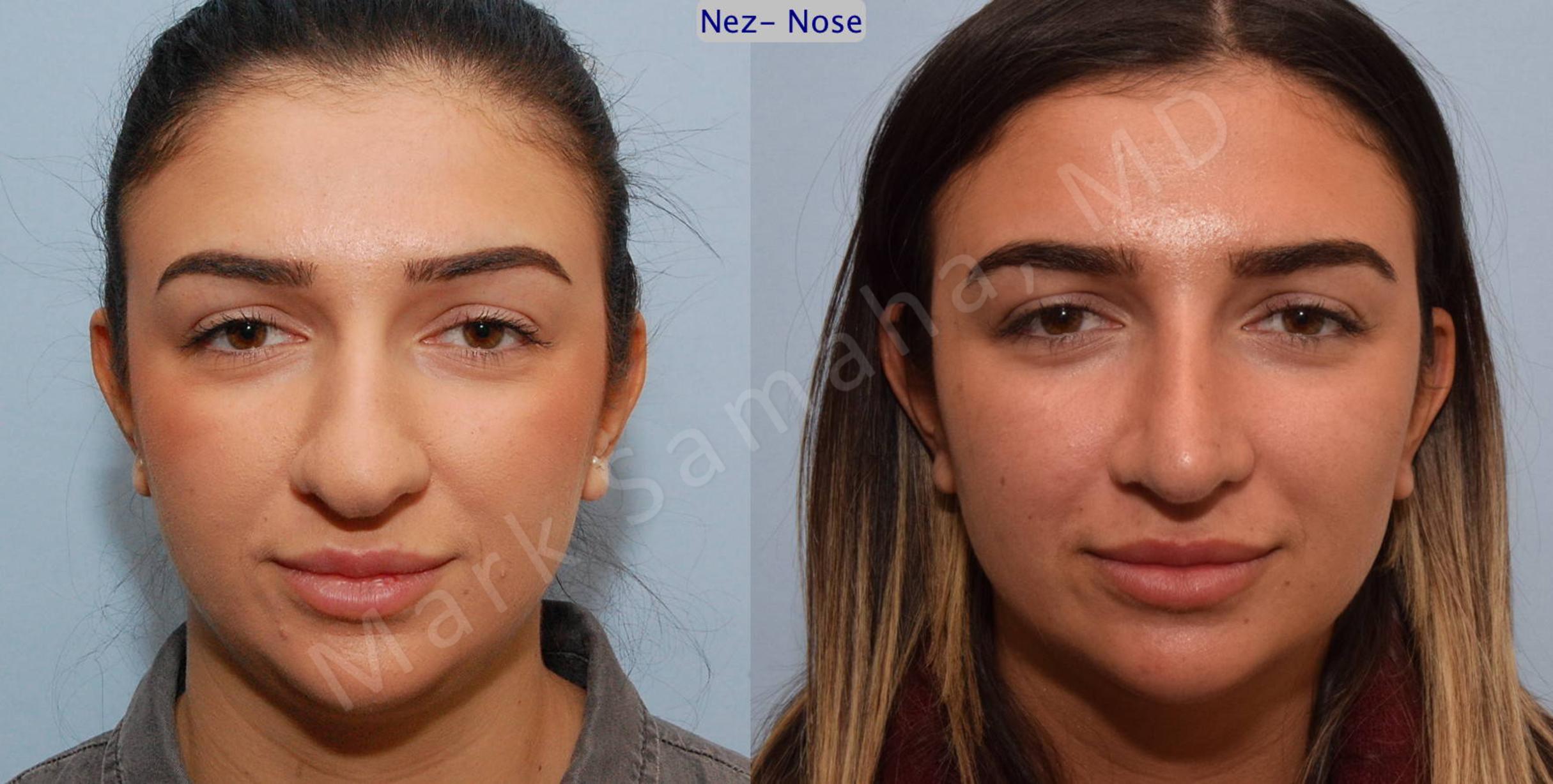 Before & After Rhinoplasty / Rhinoplastie Case 82 View #1 View in Mount Royal, QC
