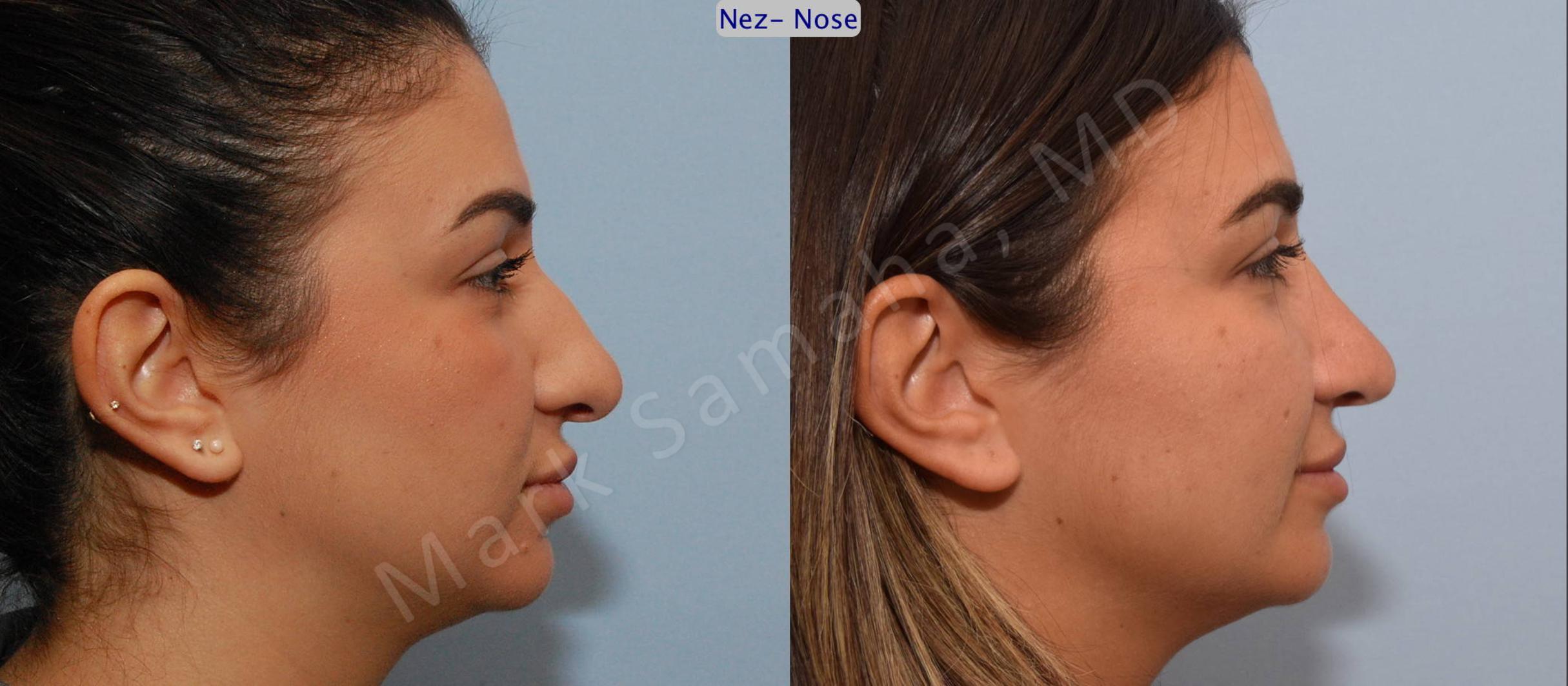 Before & After Rhinoplasty / Rhinoplastie Case 82 View #3 View in Mount Royal, QC